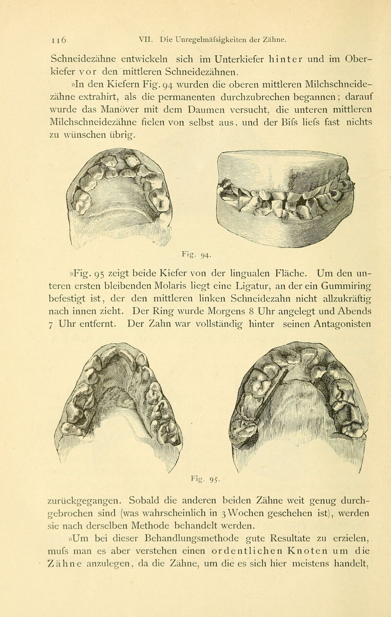 Schneidezähne entwickehi sich im Unterkiefer hinter und im Ober- kiefer vor den mittleren Schneidezähnen. »In den Kiefern Fig. 94 wurden die oberen mittleren Milchschneide- zähne extrahirt, als die permanenten durchzubrechen begannen; darauf wurde das Manöver mit dem Daumen versucht, die unteren mittleren Milchschneidezähne fielen von selbst aus. und der Bifs Hefs fast nichts zu wünschen übrig. Fig. 94. »Fig. 95 zeigt beide Kiefer von der lingualen Fläche. Um den un- teren ersten bleibenden Molaris liegt eine Ligatur, an der ein Gummiring befestigt ist, der den mittleren linken Schneidezahn nicht allzukräftig nach innen zieht. Der Ring wurde Morgens 8 Uhr angelegt und Abends 7 Uhr entfernt. Der Zahn war vollständig hinter seinen Antagonisten Fig. 95- zurückgegangen. Sobald die anderen beiden Zähne weit genug durch- gebrochen sind (was wahrscheinlich in 3 Wochen geschehen ist), werden sie nach derselben Methode behandelt werden. »Um bei dieser Behandlungsmethode gute Resultate zu erzielen, mufs man es aber ver.stehen einen ordentlichen Knoten um die Zähne anzulegen, da die Zähne, um die es sich hier mei.stens handelt.