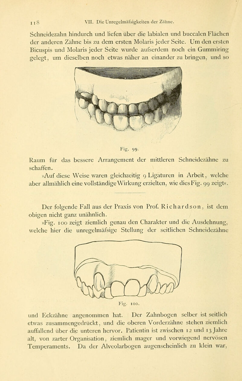 Schneidezahn hhidurch und liefen über die labialen und buccalen Flächen der anderen Zähne bis zu dem ersten Molaris jeder Seite. Um den ersten Bicuspis und Molaris jeder Seite wurde aufserdem noch ein Gummiring gelegt, um dieselben noch etwas näher an einander zu bringen, und so Fig. 99. Raum für das bessere Arrangement der mittleren Schneidezähne zu schaffen. »Auf diese Weise waren gleichzeitig g Ligaturen in Arbeit, welche aber allmählich eine vollständige Wirkung erzielten, wie dies Fig. 9g zeigt«. Der folgende Fall aus der Praxis von Prof. Richardson, ist dem obigen nicht ganz unähnlich. »Fig. 100 zeigt ziemlich genau den Charakter und die Ausdehnung, welche hier die unregelmäfsige Stellung der seitlichen Schneidezähne und Eckzähne angenommen hat. Der Zahnbogen selber ist seitlich etwas zusammengedrückt, und die oberen Vorderzähne stehen ziemlich auffallend über die unteren hervor. Patientin ist zwischen 12 und 13 Jahre alt, von zarter Organisation, ziemlich mager und vorwiegend nervösen Temperaments. Da der Alvcolarbogen augenscheinlich zu klein war,