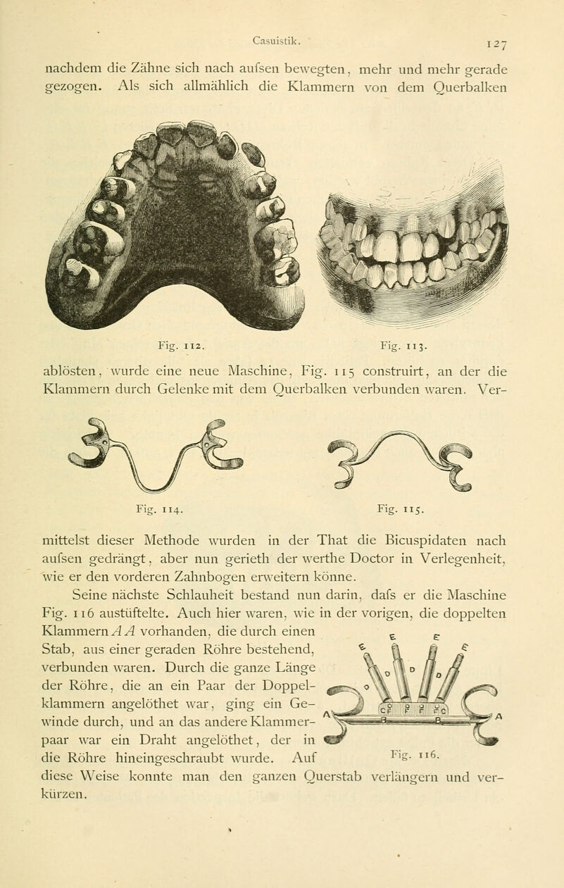12- nachdem die Zähne sich nach aufsen bewegten, mehr und mehr gerade gezogen. Als sich allmähhch die Klammern von dem Querbalken Fi£ Fig. 113. ablösten, wurde eine neue Maschine, Fig. 115 construirt, an der die Klammern durch Gelenke mit dem Querbalken verbunden waren. Ver- Fig. 114. Fig. 115. mittelst dieser Methode wurden in der That die Bicuspidaten nach aufsen gedrängt, aber nun gerieth der werthe Doctor in Verlegenheit, wie er den vorderen Zahnbogen erweitern könne. Seine nächste Schlauheit bestand nun darin, dafs er die Maschine Fig. 116 austüftelte. Auch hier waren, wie in der vorigen, die doppelten Klammern AA vorhanden, die durch einen Stab, aus einer geraden Röhre bestehend, verbunden waren. Durch die ganze Länge der Röhre, die an ein Paar der Doppel- klammern angelöthet war, ging ein Ge- winde durch, und an das andere Klammer- paar war ein Draht angelöthet, der in die Röhre hineingeschraubt wurde. Auf ^'S- 6. diese Weise konnte man den ganzen Ouerstab verlängern und \'ei kürzen.
