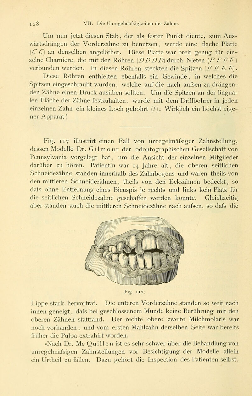 Um nun jetzt diesen Stab, der als fester Punkt diente, zum Aus- wärtsdrängen der Vorderzähne zu benutzen, wurde eine flache Platte {C C) an denselben angelöthet. Diese Platte war breit genug für ein- zelne Charniere, die mit den Röhren [DBBD) durch Nieten [F FFF) verbunden wurden. In diesen Röhren steckten die Spitzen [E E E E). Diese Röhren enthielten ebenfalls ein Gewinde, in welches die Spitzen eingeschraubt wurden, welche auf die nach aufsen zu drängen- den Zähne einen Druck ausüben sollten. Um die Spitzen an der lingua- len Fläche der Zähne festzuhalten, wurde mit dem Drillbohrer in jeden einzelnen Zahn ein kleines Loch gebohrt (/). Wirklich ein höchst eige- ner Apparat! Fig. 117 illustrirt einen Fall von unregelmäfsiger Zahnstellung, dessen Modelle Dr. Gilmour der odontographischen Gesellschaft von Pennsylvania vorgelegt hat, um die Ansicht der einzelnen Mitglieder darüber zu hören. Patientin war 14 Jahre alt, die oberen seitlichen Schneidezähne standen innerhalb des Zahnbogens und waren theils von den mittleren Schneidezähnen, theils von den Eckzähnen bedeckt, so dafs ohne Entfernung eines Bicuspis je rechts und links kein Platz für die seitlichen Schneidezähne geschaffen werden konnte. Gleichzeitig aber standen auch die mittleren Schneidezähne nach aufsen, so dafs die Fig. 117. Lippe stark hervortrat. Die unteren Vorderzähne standen so weit nach innen geneigt, dafs bei geschlossenem Munde keine Berührung mit den oberen Zähnen .stattfand. Der rechte obere zweite Milchmolaris war noch vorhanden , und vom ensten Mahlzahn derselben Seite war bereits früher die Pulpa extrahirt worden. »Nach Dr. Mc Quillen i.st es sehr schwer über die Behandlung von unregelmäfsigen Zahnstellungen vor Besichtigung der Modelle allein ein Urthcil zu fällen. Dazu gehört die Inspection des Patienten selbst,