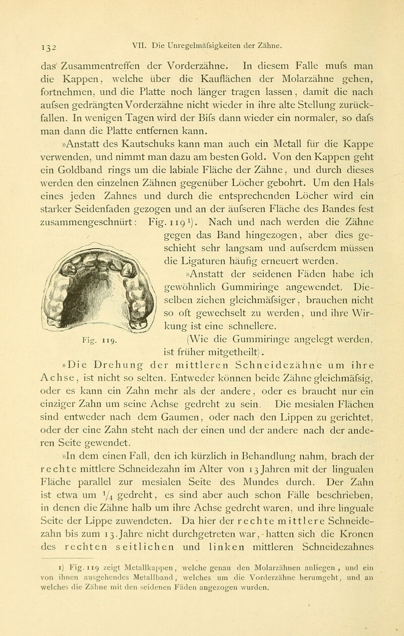 das Zusammentreffen der Vorderzähne. In diesem Falle mufs man die Kappen, welche über die Kauflächen der Molarzähne gehen, fortnehmen, und die Platte noch länger tragen lassen, damit die nach aufsen gedrängten Vorderzähne nicht wieder in ihre alte Stellung zurück- fallen. In wenigen Tagen wird der Bifs dann wieder ein normaler, so dafs man dann die Platte entfernen kann. »Anstatt des Kautschuks kann man auch ein Metall für die Kappe verwenden, und nimmt man dazu am besten Gold. Von den Kappen geht ein Goldband rings um die labiale Fläche der Zähne, und durch dieses werden den einzelnen Zähnen gegenüber Löcher gebohrt. Um den Hals eines jeden Zahnes und durch die entsprechenden Löcher wird ein starker Seidenfaden gezogen und an der äufseren Fläche des Bandes fest zusammengeschnürt: Fig. 119 i). Nach und nach werden die Zähne gegen das Band hingezogen, aber dies ge- schieht sehr langsam und aufserdem müssen die Ligaturen häufig erneuert werden. «Anstatt der seidenen Fäden habe ich gewöhnlich Gummiringe angewendet. Die- selben ziehen gieichmäfsiger, brauchen nicht so oft gewechselt zu werden, und ihre Wir- kung ist eine schnellere. (Wie die Gummiringe angelegt werden, ist früher mitgetheilt). »Die Drehung der mittleren Schneidezähne um ihre Achse, ist nicht so selten. Entweder können beide Zähnegleichmäfsig, oder es kann ein Zahn mehr als der andere, oder es braucht nur ein einziger Zahn um seine Achse gedreht zu sein. Die mesialen Flächen sind entweder nach dem Gaumen, oder nach den Lippen zu gerichtet, oder der eine Zahn steht nach der einen und der andere nach der ande- ren Seite gewendet. rtln dem einen Fall, den ich kürzlich in Behandlung nahm, brach der rechte mittlere Schneidezahn im Alter von 13 Jahren mit der lingualen Fläche parallel zur mesialen Seite des Mundes durch. Der Zahn ist etwa um Yi gedreht, es sind aber auch schon Fälle beschrieben, in denen die Zähne halb um ihre Achse gedreht waren, und ihre linguale Seite der Lippe zuwendeten. Da hier der rechte mittlere Schneide- zahn bis zum 13.Jahre nicht durchgetreten war, hatten sich die Kronen des rechten seitlichen und linken mittleren Schneidezahnes 1) Fig. 119 zeigt Metallka])pen, welche genau den Molarzälinen anliegen, und ein von ihnen ausgehendes Melallband, welches um die Vorderzähne herumgeht, und an welches die Zälme mit den seidenen Fäden angezogen wurden.