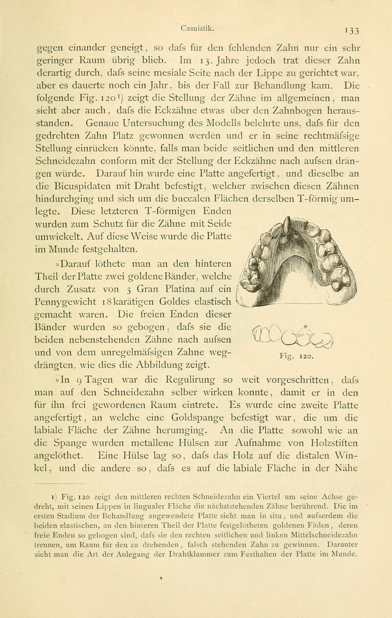 gegen einander geneigt, so dafs für den fehlenden Zahn nur ein sehr geringer Raum übrig blieb. Im 13. Jahre jedoch trat dieser Zahn derartig durch, dafs seine mesiale Seite nach der Lippe zu gerichtet war. aber es dauerte noch ein Jahr, bis der Fall zur Behandlung kam. Die folgende Fig. 120') zeigt die Stellung der Zähne im allgemeinen, man sieht aber auch, dafs die Eckzähne etwas über den Zahnbogen heraus- standen. Genaue Untersuchung des Modells belehrte uns, dafs für den gedrehten Zahn Platz gewonnen werden und er in seine rechtmäfsige Stellung einrücken könnte, falls man beide seitlichen und den mittleren Schneidezahn conform mit der Stellung der Eckzähne nach aufsen drän- gen würde. Darauf hin wurde eine Platte angefertigt, und dieselbe an die Bicuspidaten mit Draht befestigt, welcher zwischen diesen Zähnen hindurchging und sich um die buccalen Flächen derselben T-förmig um- legte. Diese letzteren T-förmigen Enden wurden zum Schutz für die Zähne mit Seide umwickelt. Auf diese Weise wurde die Platte im Munde festgehalten. »Darauf löthete man an den hinteren Tiieil der Platte zwei goldene Bänder, welche durch Zusatz von 3 Gran Piatina auf ein Pennygewicht iSkarätigen Goldes elastisch v^ gemacht waren. Die freien Enden dieser Bänder wurden so gebogen , dafs sie die (•n'^r\ ^ - x*• beiden nebenstehenden Zähne nach aufsen '^-^'l^^JC-t^ und von dem unregelmäfsigen Zahne weg- p- ^^o drängten, wie dies die Abbildung zeigt. »In 9 Tagen war die Regulirung so weit vorgeschritten, dafs man auf den Schneidezahn selber wirken konnte, damit er in den für ihn frei gewordenen Raum eintrete. Es wurde eine zweite Platte angefertigt, an welche eine Goldspange befestigt war, die um die labiale Fläche der Zähne herumging. An die Platte sowohl wie an die Spange wurden metallene Hülsen zur Aufnahme von Holzstiften angelöthet. Eine Hülse lag so, dafs das Holz auf die distalen Win- kel , und die andere so, dafs es auf die labiale Fläche in der Nähe 1) Fig. 120 zeigt den mittleren rechten Schneidezahn ein Viertel um seine Achse ge- dreht, mit seinen Lippen in lingualer Fläche die nächststehenden Zähne berührend. Die im ersten Stadium der Behandlung angewendete Platte sieht man in situ , und aufserdem die beiden elastischen, an den hinteren Theil der Platte festgelötheten goldenen Fäden, deren freie Enden so gebogen sind, dafs sie den rechten seitlichen und linken Mittelschneidezahn trennen, um Raum für den zu drehenden, falsch stehenden Zahn zu gewinnen. Darunter sieht man die Art der Anlegung der Drahtklammer zum Festhalten der Platte im Munde.