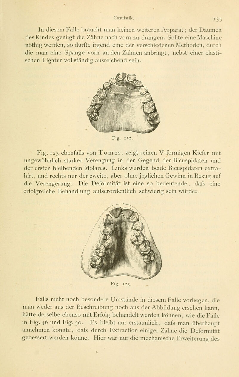 In diesem Falle braucht man keinen weiteren Apparat: der Daumen des Kindes genügt die Zähne nach vorn zu drängen. Sollte eine Maschine nöthig werden, so dürfte irgend eine der verschiedenen Methoden, durch die man eine Spange vorn an den Zähnen anbringt, nebst einer elasti- schen Ligatur vollständig ausreichend sein. Fig. 122. Fig. 123 ebenfalls von Tomes, zeigt »einen V-förmigen Kiefer mit ungewöhnlich starker Verengung in der Gegend der Bicuspidaten und der ersten bleibenden Molares. Links wurden beide Bicuspidaten extra- hirt, und rechts nur der zweite, aber ohne jeglichen Gewinn in Bezug auf die Verengerung. Die Deformität ist eine so bedeutende, dafs eine erfolgreiche Behandlung aufserordentlich schwierig sein würde«. Falls nicht noch besondere Umstände in diesem Falle vorliegen, die man weder aus der Beschreibung noch aus der Abbildung ersehen kann, hätte derselbe ebenso mit Erfolg behandelt werden können, wie die Fälle in Fig. 46 und Fig. 50. Es bleibt nur erstaunlich , dafs man überhaupt annehmen konnte, dafs durch Extraction einiger Zähne die Deformität gebessert werden könne. Hier war nur die mechanische Erweiterunp- des