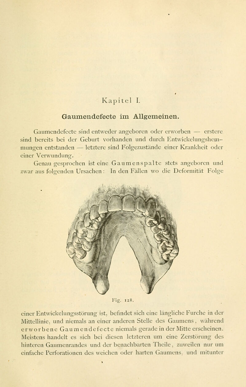 Kapitel I. Gaumendefecte im Allgemeinen. Gaumendefecte sind entweder angeboren oder erworben — erstere sind bereits bei der Geburt vorhanden und durch EntwickeUingshem- mungen entstanden — letztere sind Folgezustände einer Krankheit oder einer Verwundung. Genau gesprochen ist eine Gaumenspalte stets angeboren und zwar aus foleenden Ursachen: In den Fällen wo die Deformität Folge i'lll einer Entwickelungsstörung ist, befindet sich eine längHche Furche in der Mittellinie, und niemals an einer anderen Stelle des Gaumens. während e r w o r b e n e G a u m e n d e f e c t e niemals gerade in der Mitte erscheinen, Meistens handelt es sich bei diesen letzteren um eine Zerstörung des hinteren Gaumenrandes und der benachbarten Thcilc. zuweilen nur um einfache Perforationen des weichen oder harten Gaumens, und mitunter