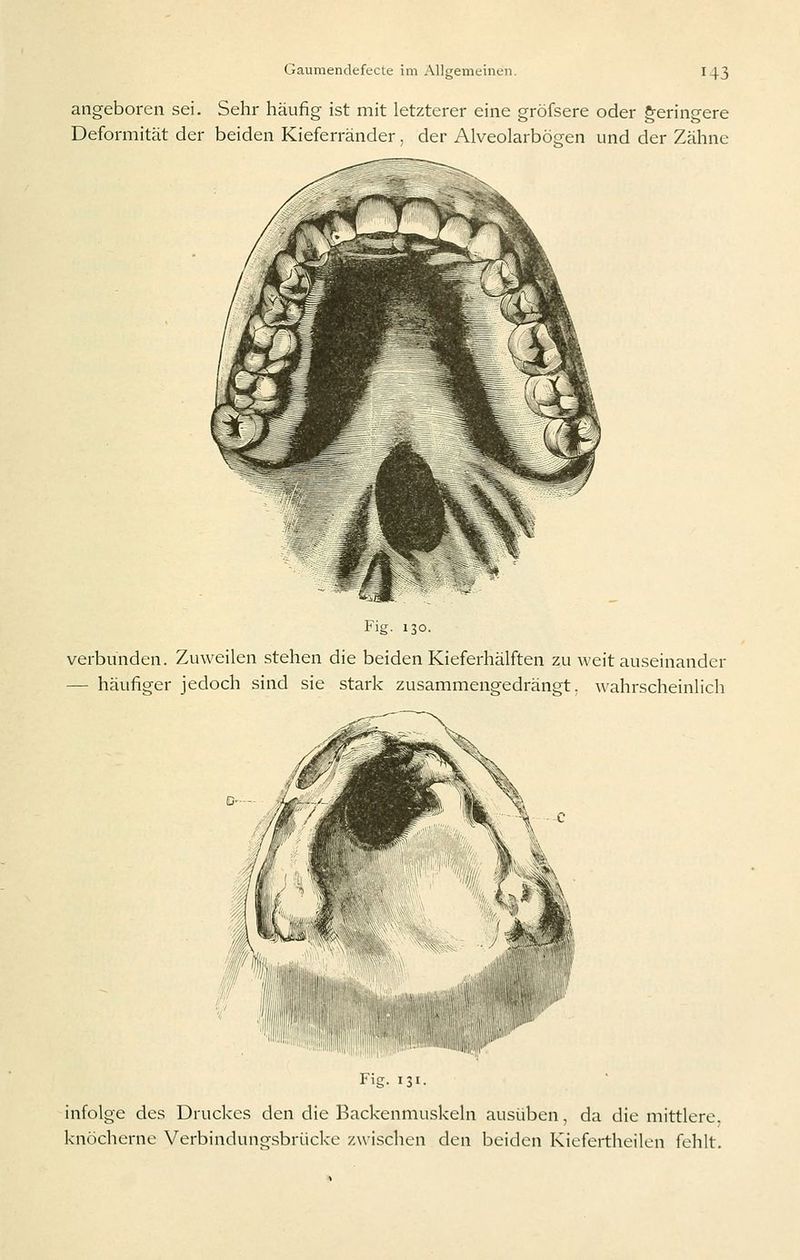 angeboren sei. Sehr häufig ist mit letzterer eine gröfsere oder g-eringere Deformität der beiden Kieferränder. der Alveolarbögen und der Zähne Fig. 130. verbunden. Zuweilen stehen die beiden Kieferhälften zu weit auseinander — häufiger jedoch sind sie stark zusammengedrängt, wahrscheinlicli Fig. 131. infolge des Druckes den die Backenmuskeln ausüben, da die mittlere, knöcherne Verbindungsbrücke zwischen den beiden Kiefertheilen fehlt.