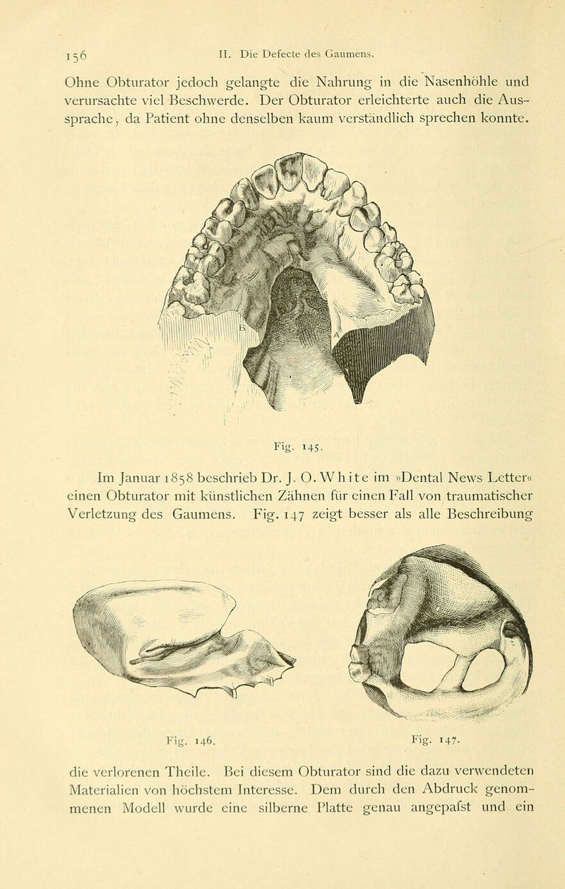 Ohne Obturator jedoch gelangte die Nahrung in die Nasenhöhle und verursachte viel Beschwerde. Der Obturator erleichterte auch die Aus- sprache, da Patient ohne denselben kaum verständlich sprechen konnte. Fig. 145- Im Januar 1858 beschrieb Dr. J. O. Wh ite im »Dental News Letter« einen Obturator mit künstlichen Zähnen für einen Fall von traumatischer Verletzung des Gaumens. Fig. 147 zeigt besser als alle Beschreibung <~^ ¥\g. 146. Fig. 147. die verlorenen Theile. Bei diesem Obturator sind die dazu verwendeten Materialien von höchstem Interesse. Dem durch den Abdruck genom- menen Modell wurde eine silberne Platte genau angepafst und ein
