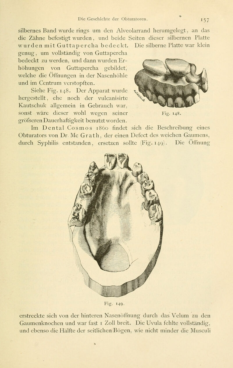 silbernes Band wurde rings um den Alveolarrand herumgelegt, an das die Zähne befestigt wurden, und beide Seiten dieser silbernen Platte wurden mit Guttapercha bedeckt. Die silberne Platte war klein genug, um vollständig von Guttapercha bedeckt zu werden, und dann wurden Er- höhungen von Guttapercha gebildet, welche die Öffnungen in der Nasenhöhle und im Centrum verstopften. Siehe Fig. 148. Der Apparat wurde hergestellt, ehe noch der vulcanisirte Kautschuk allgemein in Gebrauch war, sonst wäre dieser wohl wegen seiner gröfseren Dauerhaftigkeit benutzt worden. Im Dental Cosmos 1860 findet sich die Beschreibung eines Obturators von Dr. Mc Grath, der einen Defect des weichen Gaumens, durch Syphilis entstanden, ersetzen sollte (Fig. 149). Die Öffnung Fig. 148. erstreckte sich von der hinteren Nasenöffnung durch das Velum zu den Gaumenknochen und war fast i Zoll breit. Die Uvula fehlte vollständig, und ebenso die Hälfte der seitlichen Böefen. wie nicht minder die Musculi