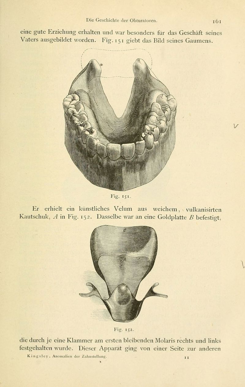 eine gute Erziehung erhalten und war besonders für das Geschäft seines Vaters ausgebildet worden. Fig. 151 giebt das Bild seines Gaumens. lig 151 Er erhielt ein künstliches Velum aus weichem, vulkanisirten Kautschuk, A in Fig. 152. Dasselbe war an eine Goldplatte B befestiot. Fig. 152. die durch je eine Klammer am ersten bleibenden Molaris rechts und links festgehalten wurde. Dieser Apparat ging von einer Seite 7a\v anderen Kingsley, Anomalien der Zahnstellung. rj V