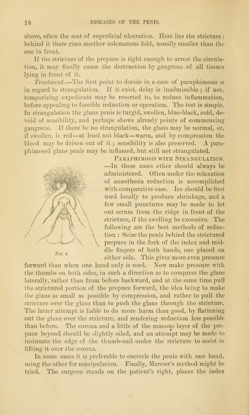 above, often the seat of superficial ulceration. Here lies the stricture : behind it there rises another aKJcmatous fold, usually smaller than the one in front. If the stricture of the prepuce is tight enougli to arrest the circula- tion, it may linally cause the destruction by gangrene of all tissues lying in front of it. 2'reatmint.—The first point to decide in a case of paraphimosis is in regard to strangulation. If it exist, delay is inadmissible ; if not, temporizing exiiedieats may be resorted to, to reduce inflammation, before appealing to forcible reduction or operation. The test is simple. In strangulation the glans penis is turgid, swollen, blue-black, cold, de- void of sensibility, and perhaps shows already points of commencing gangrene. If there be no strangulation, the glans may be normal, or, if swollen, is red—at least not black—warm, and by compression the blood may be driven out of it ; sensibility is also preserved. A para- phimosed glans penis may be inflamed, but still not strangulated. Paeaphimosis with Strangulation. —In these cases ether should always be administered. Often under the relaxation of anaesthesia reduction is accomplished with comparative ease. Ice should be first used locally to produce shrinkage, and a few small jiunctures may be made to let out serum from the ridge in front of the stricture, if the swelling be excessive. The following are the best methods of reduc- tion : Seize the penis behind the strictured prepuce in the fork of the index and mid- dle fingers of both hands, one placed on either side. This gives more even pressure forward than when one hand only is used. Now make pressure with the thumbs on both sides, in such a direction as to compress the glans laterally, rather than from before backward, and at the same time pull the strictured portion of the prepuce forward, the idea being to make the glans as small as possible by compression, and rather to pull the stricture over the glans than to push the glans through the stricture. The latter attempt is liable to do more harm than good, by flattening out the glans over the stricture, and rendering redaction less possible than before. The corona and a little of the mucous layer of the pre- puce beyond should be slightly oiled, and an attempt may be made to insinuate the edge of the thumb-nail under the stricture to assist in lifting it over the corona. In some cases it is preferable to encircle the penis with one hand, using the other for manipulation. Finally, Mercier's method might be tried. The surgeon stands on the patient's right, places the index