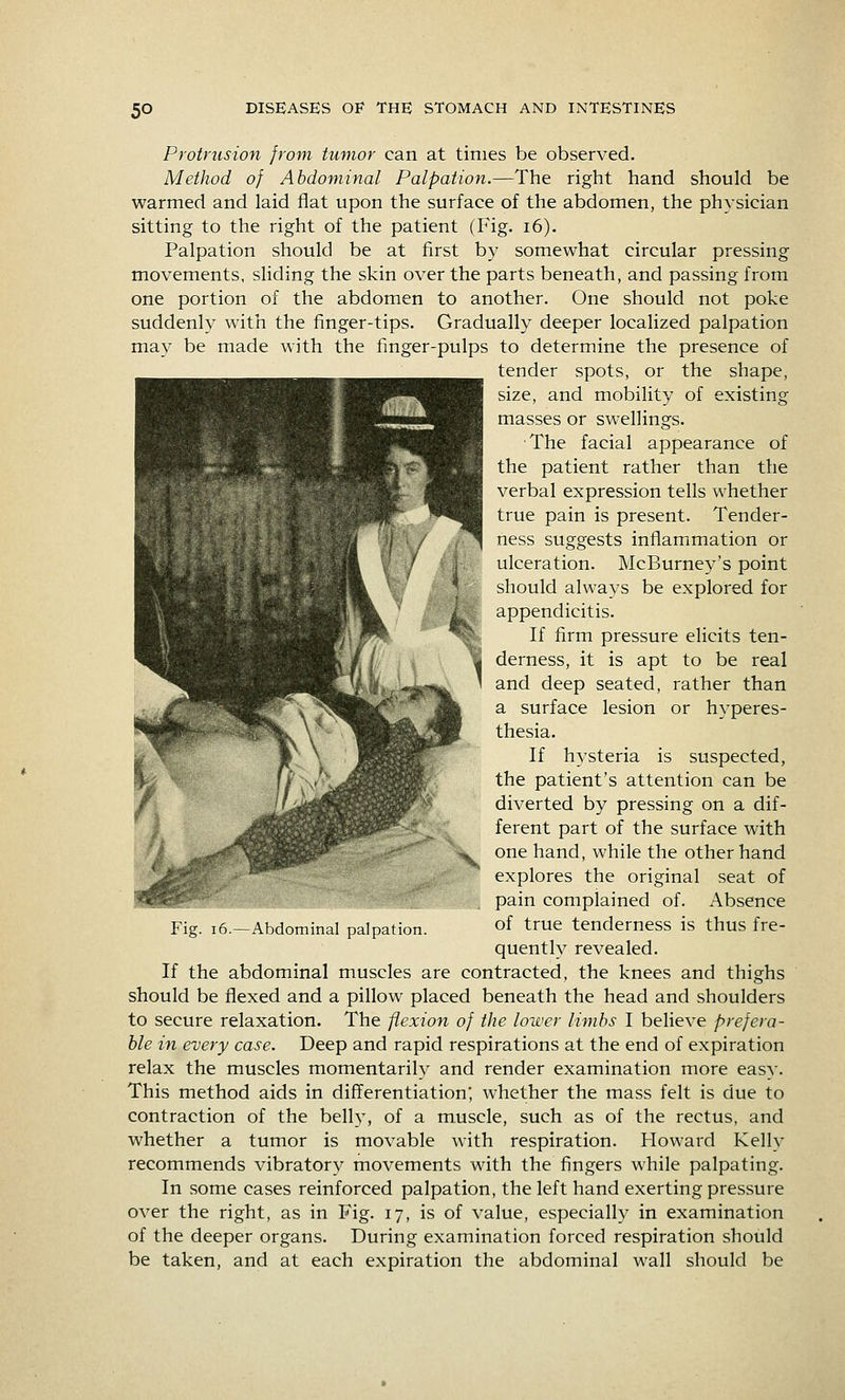 Protrusion from tumor can at times be observed. Method of Abdominal Palpation.—The right hand should be warmed and laid flat upon the surface of the abdomen, the physician sitting to the right of the patient (Fig. i6). Palpation should be at first by somewhat circular pressing movements, sliding the skin over the parts beneath, and passing from one portion of the abdomen to another. One should not poke suddenly with the finger-tips. Gradually deeper localized palpation may be made with the finger-pulps to determine the presence of tender spots, or the shape, size, and mobility of existing masses or swellings. The facial appearance of the patient rather than the verbal expression tells whether true pain is present. Tender- ness suggests inflammation or ulceration. McBurney's point should always be explored for appendicitis. If firm pressure elicits ten- derness, it is apt to be real and deep seated, rather than a surface lesion or hyperes- thesia. If hysteria is suspected, the patient's attention can be diverted by pressing on a dif- ferent part of the surface with one hand, while the other hand explores the original seat of pain complained of. Absence of true tenderness is thus fre- quently revealed. If the abdominal muscles are contracted, the knees and thighs should be flexed and a pillow placed beneath the head and shoulders to secure relaxation. The flexion of the lower limbs I believe prefera- ble in every case. Deep and rapid respirations at the end of expiration relax the muscles momentarily and render examination more easy. This method aids in differentiation; whether the mass felt is due to contraction of the belly, of a muscle, such as of the rectus, and whether a tumor is movable with respiration. Howard Kelly recommends vibratory movements with the fingers while palpating. In some cases reinforced palpation, the left hand exerting pressure over the right, as in Fig. 17, is of value, especially in examination of the deeper organs. During examination forced respiration should be taken, and at each expiration the abdominal wall should be Fig. 16.—Abdominal palpation.