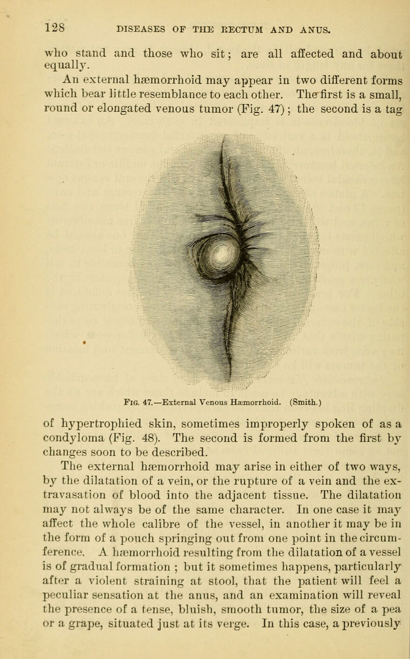 who stand and those who sit; are all affected and about equally. An external hemorrhoid may appear in two different forms which bear little resemblance to each other. The first is a small, round or elongated venous tumor (Fig. 47); the second is a tag Fig. 47.—External Venous Haemorrhoid. (Smith.) of hypertrophied skin, sometimes improperly spoken of as a condyloma (Fig. 48). The second is formed from the first by changes soon to be described. The external haemorrhoid may arise in either of two ways, by the dilatation of a vein, or the rupture of a vein and the ex- travasation of blood into the adjacent tissue. The dilatation may not always be of the same character. In one case it may affect the whole calibre of the vessel, in another it may be in the form of a pouch springing out from one point in the circum- ference. A haemorrhoid resulting from the dilatation of a vessel is of gradual formation ; but it sometimes happens, particularly after a violent straining at stool, that the patient will feel a peculiar sensation at the anus, and an examination will reveal the presence of a tense, bluish, smooth tumor, the size of a pea or a grape, situated just at its verge. In this case, a previously