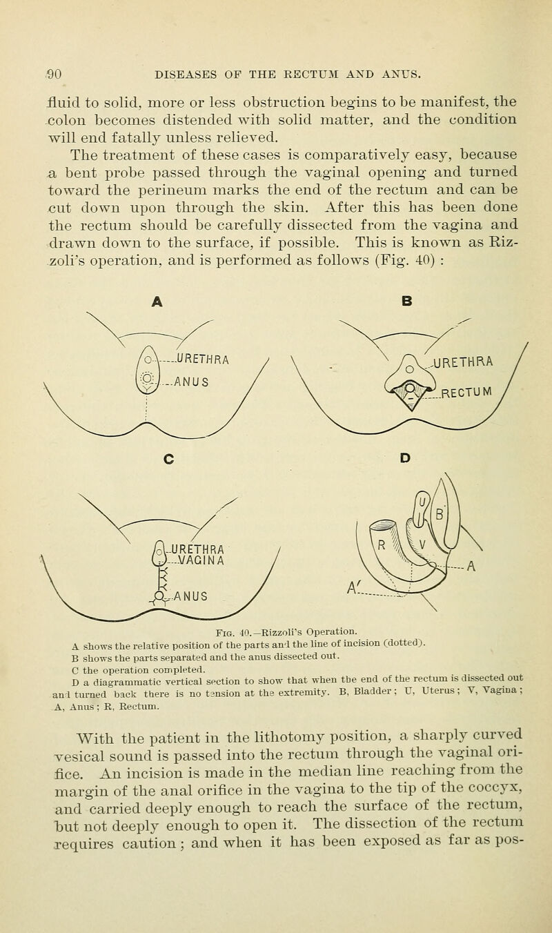 iiuid to solid, more or less obstruction begins to be manifest, the colon becomes distended with solid matter, and the condition will end fatally unless relieved. The treatment of these cases is comparatively easy, because a bent probe passed through the vaginal opening and turned toward the perineum marks the end of the rectum and can be €ut down upon through the skin. After this has been done the rectum should be carefully dissected from the vagina and drawn down to the surface, if possible. This is known as Riz- zoli's operation, and is performed as follows (Fig. 40) : Fig. 40.—Rizzoli's Operation. A slLOWs the relative position of the parts an'l the line of incision (dotted). B sho-svs the parts separated and the anus dissected out. C the opei'ation corripleted. D a diagrammatic vertical section to show that when the end of the rectum is dissected out an 1 turned back there is no tension at the extremity. B, Bladder; U, Uterus; V, Vagma; A, Anus ; E, Rectum. With the patient in the lithotomy position, a sharply curved vesical sound is passed into the rectum through the vaginal ori- fice. An incision is made in the median line reaching from the margin of the anal orifice in the vagina to the tip of the coccyx, and carried deeply enough to reach the surface of the rectum, hut not deeply enough to open it. The dissection of the rectum Tequires caution; and when it has been exposed as far as pos-