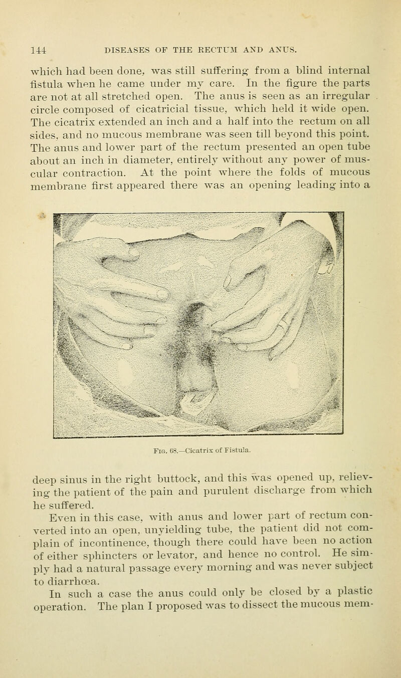 which had been clone, was still suffering from a blind internal fistula when he came under my care. In the figure the parts are not at all stretched open. The anus is seen as an irregular circle composed of cicatricial tissue, which held it wide open. The cicatrix extended an inch and a half into the rectum on all sides, and no mucous membrane was seen till beyond this point. The anus and lower part of the rectum presented an open tube about an inch in diameter, entirely without any power of mus- cular contraction. At the point where the folds of mucous membrane first appeared there was an opening leading into a '■Mi Fig. 68.—Cicatrix of Fistula. deep sinus in the right buttock, and this was opened up, reliev- ing the patient of the pain and purulent discharge from which he suffered. Even in this case, with anus and lower part of rectum con- verted into an open, unyielding tube, the patient did not com- plain of incontinence, though there could have been no action of either sphincters or levator, and hence no control. He sim- ply had a natural passage every morning and was never subject to diarrhoea. In such a case the anus could only be closed by a plastic operation. The plan I proposed was to dissect the mucous mem-