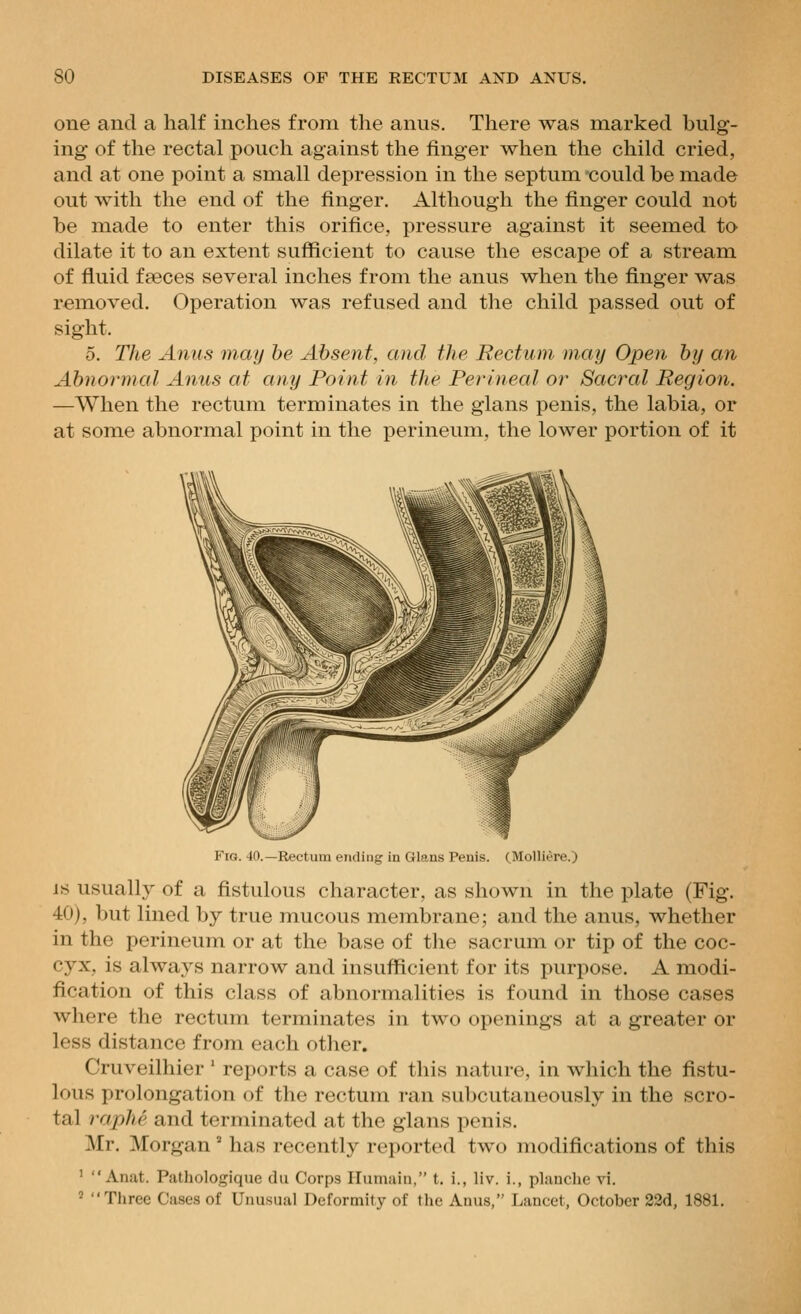 one and a half inches from the anus. There was marked bulg- ing of the rectal pouch against the finger when the child cried, and at one point a small depression in the septum -could be made out with the end of the finger. Although the finger could not be made to enter this orifice, pressure against it seemed to dilate it to an extent sufficient to cause the escape of a stream of fluid feeces several inches from the anus when the finger was removed. Operation was refused and the child passed out of sight. 5. The Anus may he Absent, and the Rectum may Open by an Abnormal Anus at any Point in the Perineal or Sacral Region. —When the rectum terminates in the glans penis, the labia, or at some abnormal point in the perineum, the lower portion of it Fig 40 —Rectum ending in Glans Penis. (Molliere.) IS usually of a fistulous character, as shown in the plate (Fig. 40), but lined by true mucous membrane; and the anus, whether in the perineum or at the base of the sacrum or tip of the coc- cyx, is always narrow and insufficient for its purpose. A modi- fication of this class of abnormalities is found in those cases where the rectum terminates in two openings at a greater or less distance from each other. Cruveilhier ' reports a case of this nature, in which the fistu- lous prolongation of the rectum ran subcutaneously in the scro- tal raphe and terminated at the glans penis. Mr. Morgan  has recently reported two modifications of this '  Anat. Pathologique du Corps Ilumain, t. i., liv. i., plauche vi. ' Tlirec Cases of Unusual Deformity of the Anus, Lancet, October 22d, 1881.