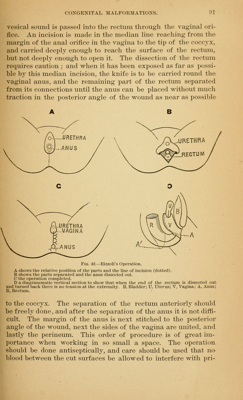 vesical sound is passed into the rectum through the vaginal ori- fice. An incision is made in the median line reaching from the margin of the anal orifice in the vagina to the tip of the coccyx, and carried deeply enough to reach the surface of the rectum, but not deeply enough to open it. The dissection of the rectum requires caution ; and when it has been exposed as far as possi- ble by this median incision, the knife is to be carried round the vaginal anus, and the remaining part of the rectum separated from its connections until the anus can be placed without much traction in the posterior angle of the wound as near as possible Fig. 42.—Rizzoli's Operation. A shoe's the relative position of the parts and the line of incision (dotted). B shows the parts separated and the anus dissected out. C the operation completed. D a diagrammatic vertical section to show that when the end of the rectum is dissected out and turned back there is no tension at the extremity. B, Bladder; U, Uterus; V, Vagina; A, Anus; R, Rectum. to the coccyx. The separation of the rectum anteriorly should be freely done, and after the separation of the anus it is not diffi- cult. The margin of the anus is next stitched to the posterior angle of the wound, next the sides of the vagina are united, and lastly the perineum. This order of procedure is of great im- portance when working in so small a space. The operation should be done antiseptically, and care should be used that no blood between the cut surfaces be allowed to interfere with pri-