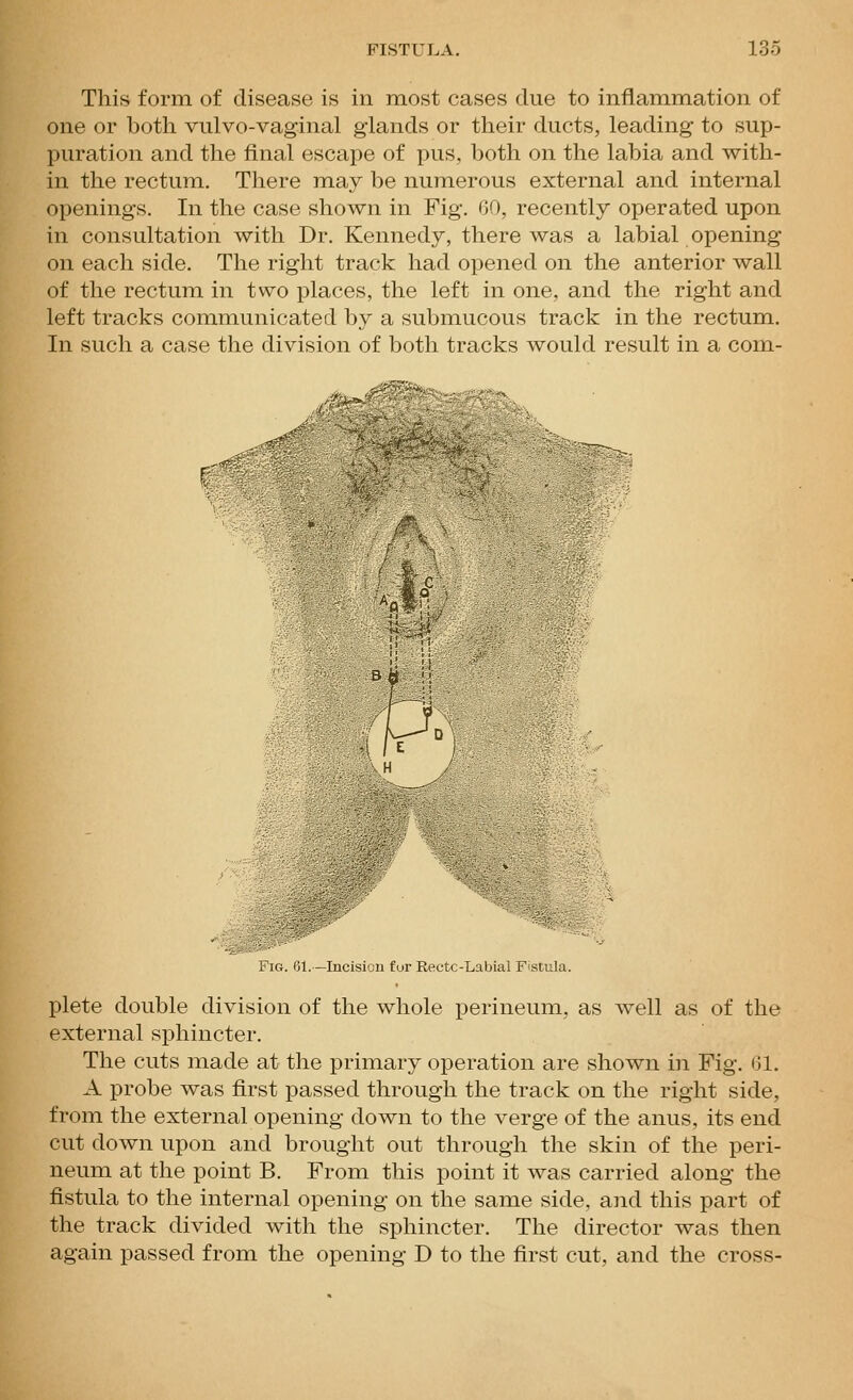 This form of disease is in most cases due to inflammation of one or both vulvo-vaginal glands or their ducts, leading to sup- puration and the final escape of pus, both on the labia and with- in the rectum. There may be numerous external and internal openings. In the case shown in Fig. GO, recently operated upon in consultation with Dr. Kennedy, there was a labial opening on each side. The right track had opened on the anterior wall of the rectum in two places, the left in one, and the right and left tracks communicated by a submucous track in the rectum. In such a case the division of both tracks would result in a com- r Ur. iU.—Incision for Rectc-Labial Fistula. plete double division of the whole perineum, as well as of the external sphincter. The cuts made at the primary operation are shown in Fig. 61. A probe was first passed through the track on the right side, from the external opening down to the verge of the anus, its end cut down upon and brought out through the skin of the peri- neum at the point B. From this point it was carried along the fistula to the internal opening on the same side, and this part of the track divided with the sphincter. The director was then again passed from the opening D to the first cut, and the cross-