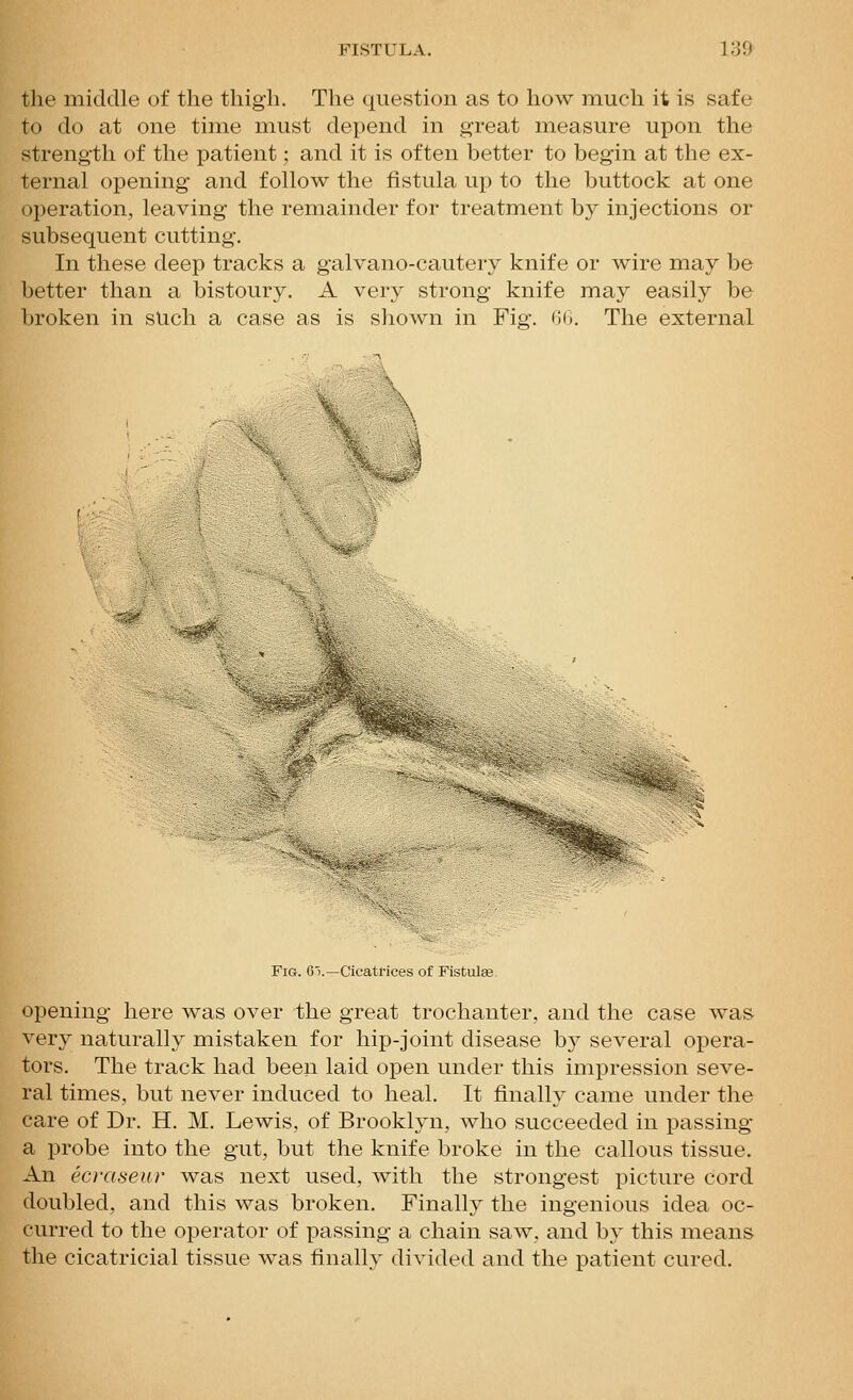 FISTULA. 1;j'J the middle of the thigh. The question as to how much it is safe to do at one time must depend in great measure upon the strength of the patient; and it is often better to begin at the ex- ternal opening and follow the fistula up to the buttock at one operation, leaving the remainder for treatment by injections or subsequent cutting. In these deep tracks a galvano-cautery knife or wire may be better than a bistoury. A very strong knife may easily be broken in sUch a case as is shown in Fig. 00. The external Fig. 6).—Cicatrices of Fistula opening here was over the great trochanter, and the case was very naturally mistaken for hip-joint disease by several opera- tors. The track had been laid open under this impression seve- ral times, but never induced to heal. It finally came under the ca,re of Dr. H. M. Lewis, of Brooklyn, who succeeded in passing a probe into the gut, but the knife broke in the callous tissue. An ecraseur was next used, with the strongest picture cord doubled, and this was broken. Finally the ingenious idea oc- curred to the operator of passing a chain saw, and by this means the cicatricial tissue was finally divided and the patient cured.