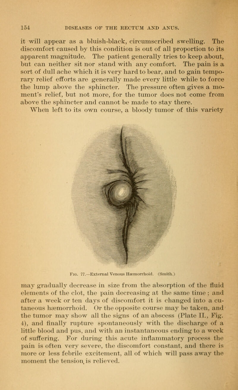 it Avill appear as a bluish-black, circumscribed swelling. The discomfort caused by this condition is out of all proportion to its apparent magnitude. The patient generally tries to keep about, but can neither sit nor stand with any comfort. The pain is a sort of dull ache which it is very hard to bear, and to gain tempo- rary relief efforts are generally made every little while to force the lump above the sphincter. The pressure often gives a mo- ment's relief, but not more, for the tumor does not come from above the sphincter and cannot be made to stay there. When left to its own course, a bloody tumor of this variety Fig. 77.—External Venous Haemorrlioid. (Smith.) may gradually decrease in size from the absorption of the fluid elements of the clot, the pain decreasing at the same time ; and after a week or ten days of discomfort it is changed into a cu- taneous h«3morrhoid. Or the opposite course may be taken, and the tumor may show all the signs of an abscess (Plate II., Fig. 4), and finally rupture spontaneously with the discharge of a little blood and ])us, and with an instantaneous ending to a week of suffering. For during this acute inflammatory process the pain is often very severe, the discomfort constant, and there is more or less febrile excitement, all of which will pass away the moment the tension is relieved.