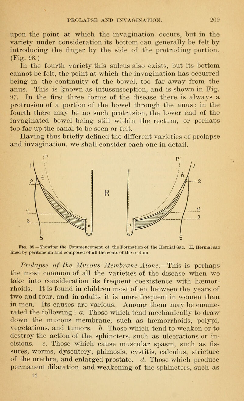 upon the point at which the invagination occurs, but in the variety under consideration its bottom can generally be felt by introducing the finger by the side of the protruding portion. (Fig. 98.) In the fourtli variety this sulcus also exists, but its bottom cannot be felt, the point at which the invagination has occurred being in the continuity of the bowel, too far away from the anus. This is known as intussusception, and is shown in Fig. 07. In the first three forms of the disease there is always a protrusion of a portion of the bowel through the anus ; in the fourth there may be no such protrusion, the lower end of the invaginated bowel being still within the rectum, or perhaps too far up the canal to be seen or felt. Having thus briefly defined the different varieties of prolapse and invagination, we shall consider each one in detail. R Fig. 98 —Showing the Commencement of the Formation of the Hernial Sac. lined by peritoneum and composed of all the coats of the rectum. H, Hernial sac Prolapse of the Mucous Memhrane Alone.—This is perhaps the most common of all the varieties of the disease when we take into consideration its frequent coexistence with hsemor- rhoids. It is found in children most often between the years of two and four, and in adults it is more frequent in woixien than in men. Its causes are various. Among them may be enume- rated the following : a. Those which tend mechanically to draw down the mucous membrane, such as haemorrhoids, polypi, vegetations, and tumors, h. Those which tend to weaken or to destroy the action of the sphincters, such as ulcerations or in- cisions, c. Those which cause muscular spasm, such as fis- sures, worms, dysentery, phimosis, cystitis, calculus, stricture of the urethra, and enlarged prostate, d. Those which produce permanent dilatation and weakening of the sphincters, such as 14