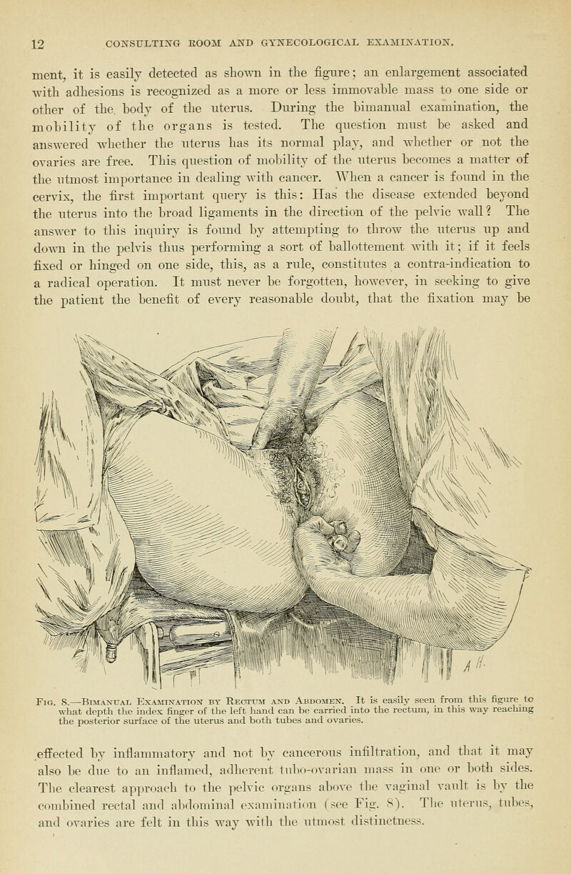 ment, it is easily detected as shoAvn in the figure; an enlargement associated with adhesions is recognized as a more or less immovable mass to one side or other of the. body of the uterus. During the bimanual examination, the mobility of the organs is tested. The question must be asked and answered whether the uterus has its normal play, and whether or not the ovaries are free. This question of mobility of the uterus becomes a matter of the utmost importance in dealing with cancer. When a cancer is found in the cervix, the first important query is this: Has the disease extended beyond the uterus into the broad ligaments in the direction of the pelvic wall? The answer to this inquiry is found by attempting to throw the uterus up and down in the pelvis thus performing a sort of ballottement with it; if it feels fixed or hinged on one side, this, as a rule, constitutes a contra-indication to a radical operation. It must never be forgotten, however, in seeking to give the patient the benefit of every reasonable doubt, that the fixation may be Fig. 8.—BmANUAL Examination by Rectum and Abdomen. It is easily seen from this figure to what depth the index finger of the left hand can be carried into the rectum, in this way reaching the posterior surface of the uterus and both tubes and ovaries. effected by inflammatory and not by cancerous infiltration, and that it may also be due to an inflamed, adherent tubo-ovarian mass in one or both sides. The clearest approach to the pelvic organs above the vaginal vault is by the combined rectal and abdominal examination (see Fig. 8). The uterus, tubes, and ovaries are felt in this wav with the utmost distinctness.