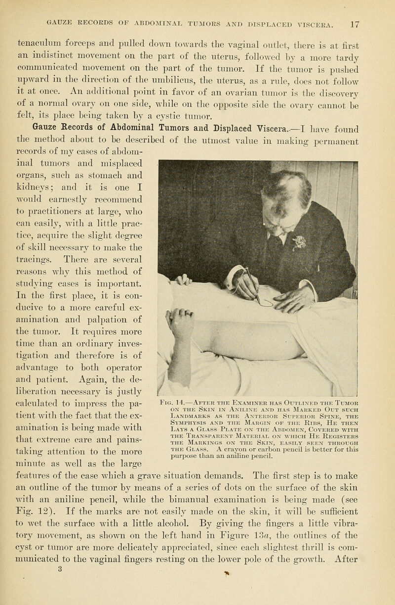 tenaculum forceps and pulled down towards the vaginal outlet, there is at first an indistinct movement on the part of the uterus, followed by a more tardy communicated movement on the part of the tumor. If the tumor is pushed upward in the direction of the umbilicus, the uterus, as a rule, does not follow it at once. An additional point in favor of an ovarian tumor is the discovery of a normal ovary on one side, while on the opposite side the ovary cannot be felt, its place being taken by a cystic tumor. Gauze Records of Abdominal Tumors and Displaced Viscera.-—I have found the method about to be described of the utmost value in making permanent records of my cases of abdom- inal tumors and misplaced organs, such as stomach and kidneys; and it is one I would earnestly recommend to ^practitioners at large, who can easily, with a little prac- tice, acquire the slight degree of skill necessary to make the tracings. There are several reasons wdiy this method of studying cases is important. In the first place, it is con- ducive to a more careful ex- amination and palpation of the tumor. It requires more time than an ordinary inves- tigation and therefore is of advantage to both operator and patient. Again, the de- liberation necessary is justly calculated to impress the pa- tient with the fact that the ex- amination is being made with that extreme care and pains- taking attention to the more minute as well as the large features of the case which a grave situation demands. The first step is to make an outline of the tumor by means of a series of dots on the surface of the skin with an aniline pencil, while the bimanual examination is being made (see Fig. 12). If the marks are not easily made on the skin, it will be sufiicient to wet the surface with a little alcohol. By giving the fingers a little vibra- tory movement, as shown on the left hand in Figure 13a, the outlines of the cyst or tumor are more delicately appreciated, since each slightest thrill is com- municated to the vaginal fingers resting on the lower pole of the growth. After ->%- .. i J Fig. 14.—After the Examiner has Outlined the Tumor ON THE Skin in Aniline and has Marked Out such Landmarks as the Anterior Sxtperior Spine, the Symphysis and the Margin of the Ribs, He then Lays a Glass Plate on the Abdomen, Covered with THE Transparent Material on which He Registers the Markings on the Skin, easily seen through the Glass. A crayon or carbon pencil is better for this purpose than an aniline pencil.