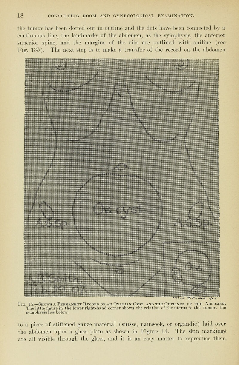 the tinnor lias been dotted out in outline and the dots have been connected by a continuous line, the landmarks of the abdomen, as the symphysis, the anterior superior spine, and the margins of the ribs are outlined with aniline (see Fig. 136). The next step is to make a transfer of the record on the abdomen Fig. 15.—Shows a Permanent Record of an Ovarian Cyst and the Outlines of the Abdomen. The little figure in the lower right-hand corner shows the relation of the uterus to the tumor, the symphysis lies below. to a piece of stiffened gauze material (Suisse, nainsook, or organdie) laid over the abdomen upon a glass plate as shown in Figure l-i. The skin markings are all visible through the glass, and it is an easy matter to reproduce them
