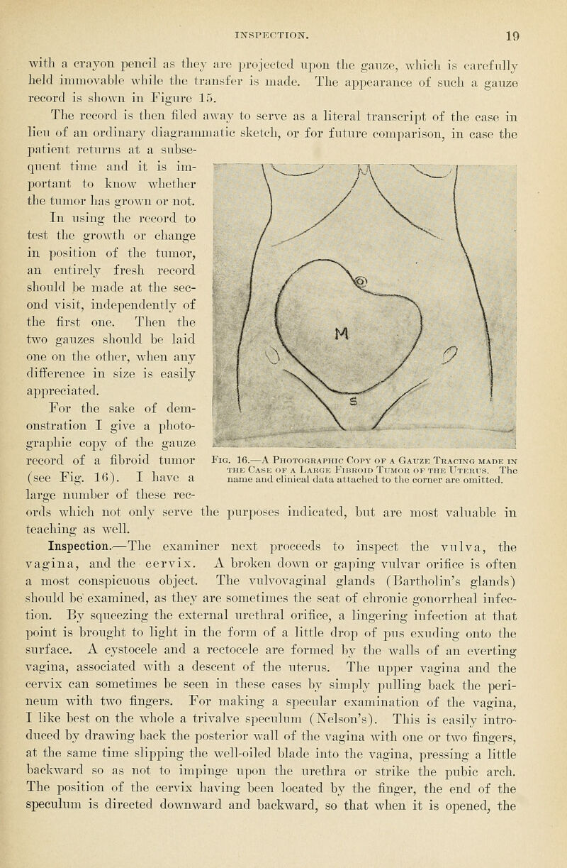with a crayon pencil as tliey are projected npon tlie gauze, which is carefnlly held immovable while the transfer is made. The appearance of such a gauze record is shown in Figure 15. The record is then filed away to serve as a literal transcript of the case in lieu of an ordinary diagrammatic sketch, or for future comparison, in case the patient returns at a subse- quent time and it is im- portant to know whether the tumor has grown or not. In using the record to test the growth or change in position of the tumor, an entirely fresh record should be made at the sec- ond visit, independently of the first one. Then the two gauzes should be laid one on the other, when any difi^erence in size is easily appreciated. For the sake of dem- onstration I give a photo- graphic copy of the gauze record of a fibroid tumor (see Fig. 16). I have a large number of these rec- ords which not only serve the purposes indicated, but are most valuable in teaching as well. Inspection.—The examiner next proceeds to inspect the vulva, the vagina, and the cervix. A broken down or gaping vulvar orifice is often a most conspicuous object. The vulvovaginal glands (Bartholin's glands) should be' examined, as they are sometimes the seat of chronic gonorrheal infec- tion. By squeezing the external urethral orifice, a lingering infection at that point is brought to light in the form of a little drop of pus exuding onto the surface. A cystocele and a rectocele are formed by the walls of an everting vagina, associated with a descent of the uterus. The upper vagina and the cervix can sometimes be seen in these cases by simply pulling back the peri- neum with two fingers. For making a specular examination of the vagina, I like best on the wdiole a trivalve speculum (JSTelson's). This is easily intro- duced by drawing back the posterior wall of the vagina with one or two fingers, at the same time slipping the well-oiled blade into the vagina, pressing a little backward so as not to impinge upon the urethra or strike the pubic arch. The position of the cervix having been located by the finger, the end of the speculum is directed downward and backward, so that when it is opened, the Fig. 16.—A Photographic Copy of a Gauze Tracing made in THE Case of a Large Fibroid Tumor of the Uterus. The name and clinical data attached to the corner are omitted.
