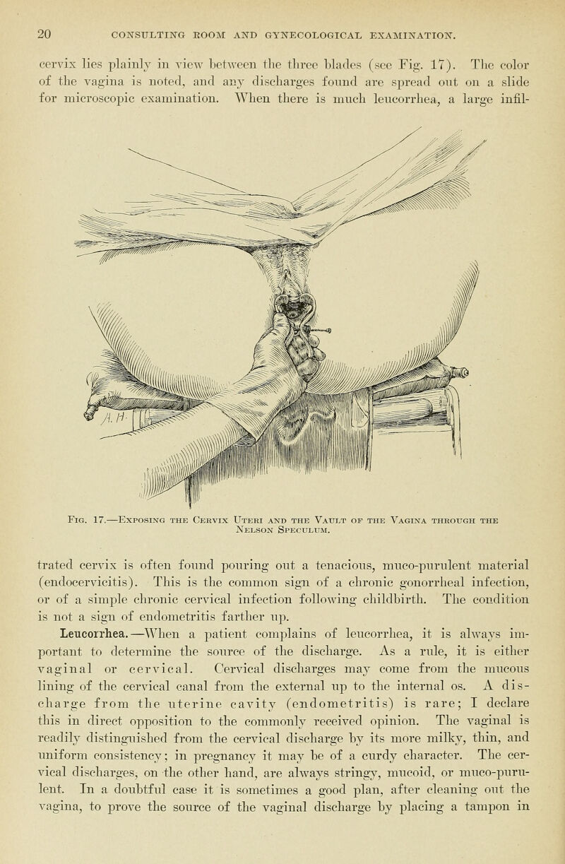 cervix lies plainly in view between the three blades (see Fig. 17). The color of the vagina is noted, and any discharges found are spread out on a slide for microscojjic examination. When there is much leucorrhea, a large infil- FiG. 17.—Exposing the Cervix Uteri and the Vatti^t of the Vagina through the Nelson SPEcuLmi. trated cervix is often found pouring out a tenacious, mueo-purulent material (endocervicitis). This is the common sign of a chronic gonorrheal infection, or of a simple chronic cervical infection following childbirth. The condition is not a sign of endometritis farther up. Leucorrhea.—^\Vhen a patient complains of leucorrhea, it is always im- portant to determine the source of the discharge. As a rule, it is either vaginal or cervical. Cervical discharges may come from the mucous lining of the cervical canal from the external up to the internal os. A dis- charge from the uterine cavity (endometritis) is rare; I declare this in direct opposition to the commonly received opinion. The vaginal is readily distinguished from the cervical discharge by its more milky, thin, and uniform consistency; in pregnancy it may be of a curdy character. The cer- vical discharges, on the other hand, are always stringy, mucoid, or muco-puru- lent. In a doubtful case it is sometimes a good plan, after cleaning out the vagina, to prove the source of the vaginal discharge by placing a tampon in