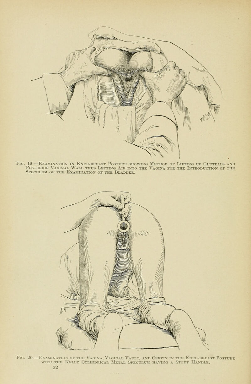 Fig. 19 —ExjoniN-ATTOX zn Kxee-breast Posttee shotvixg ^Iethod of Lifttxg up Glttteai-s axd Posterior Vagixai, Wall thts Lettln'g Air rxro the Vagin^a foe the Lsteoductiox of the Speculttm or the Examixatiox of the Bladder. Fig. 20.—ExA^r^^■ATIo^ of the Vagina, S'agixal Vatt-t, axd CER^•IX ix the Kxee-breast Posture A^^TH the Kelly Ctlixdrical !Metal Speculum haatxg a Stout Haxdle.