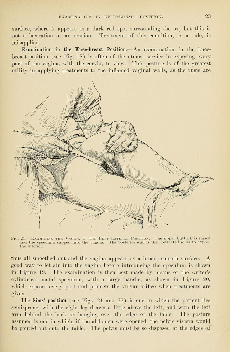 surface, where it appears as a dark red spot surrounding the os; but this is not a laceration or an erosion. Treatment of this condition, as a rule, is misapplied. Examination in the Knee-breast Position.—An examination in the knee- breast position (see Fig. 18) is often of the utmost service in exposing every part of the vagina, with the cervix, to view. This posture is of the greatest utility in applying treatments to the inflamed vaginal walls, as the rugse are Fig. 21.—Examining the Vagina in the Left Lateral Position. The upper buttock is raised and the speculum slipped into the vagina. The posterior wall is then retracted so as to expose the interior. thus all smoothed out and the vagina appears as a broad, smooth surface. A good way to let air into the vagina before introducing the speculum is shown in Figure 19. The examination is then best made by means of the writer's cylindrical metal speculum, with a large handle, as shown in Figure 20, which exposes every part and protects the vulvar orifice when treatments are given. The Sims' position (see Figs. 21 and 22) is one in which the patient lies semi-prone, with the right leg drawn a little above the left, and with the left arm behind the back or hanging over the edge of tlie table. The posture assumed is one in which, if the abdomen were opened, the pelvic viscera would be poured out onto the table. The pelvis must be so disposed at the edges of
