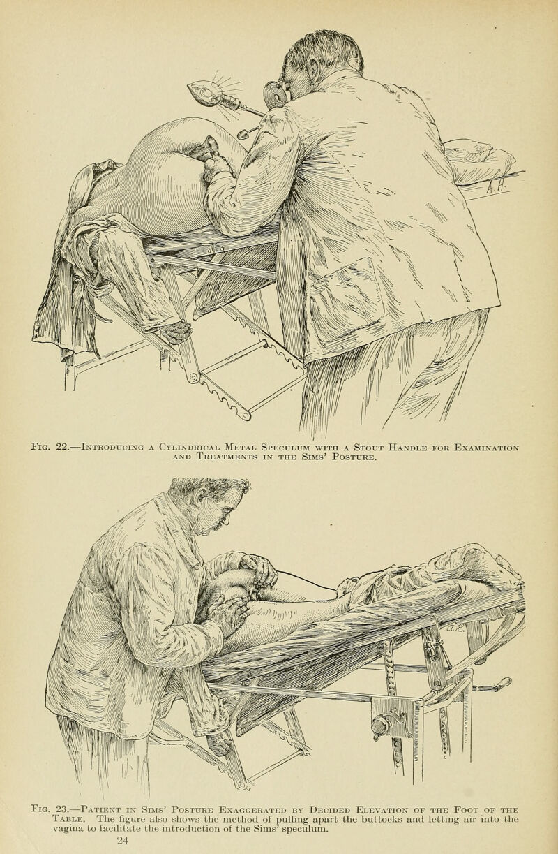 Fig. 22.—Inteodxjcing a Cylindrical Metal Speculum with a Stout Handle for Examination AND Treatments in the Sims' Posture. Fig. 23.—Patient in Sims' Posture Exaggerated by Decided Elevation or the Foot of the Table. The figure also shows the method of pulling apart the buttocks and letting air into the vagina to facilitate the introduction of the Sims' speculum.
