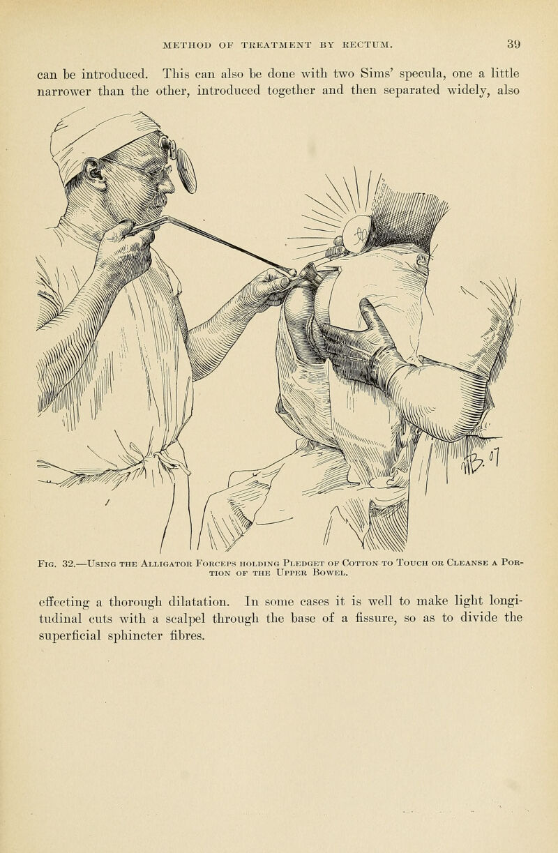 can be introduced. This can also be done with two Sims' specula, one a little narrower than the other, introduced together and then separated widely, also Fig. 32.—Using the Alligator Forceps holding Pledget op Cotton to Touch or Cleanse a Por- tion OF the Upper Bowel. effecting a thorough dilatation. In some cases it is well to make light longi- tudinal cuts with a scalpel through the base of a fissure, so as to divide the superficial sphincter fibres.
