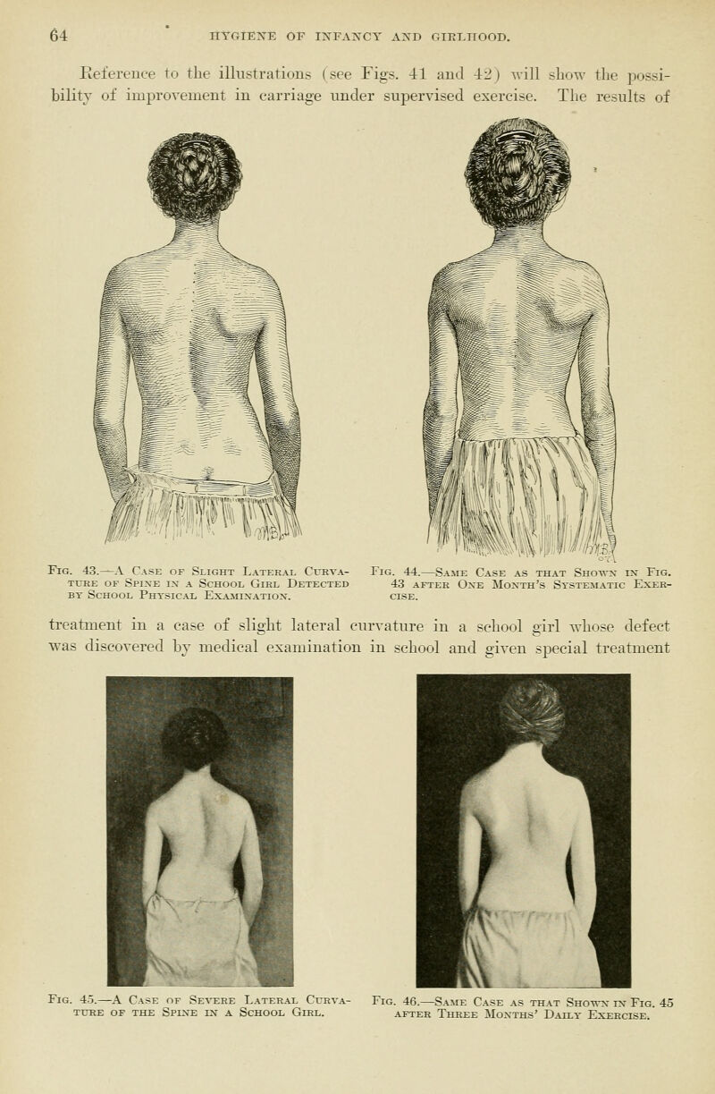 Eeference to the illustrations (see Figs, -il aud 4il) Avill show the possi- bility of improTcmcnt iu carriage under supervised exercise. The results of Fig. 43.—A Case of Slight Lateral Cueva- Fig. 44.—Same Case as that Shotvx in Fig. TURE OF SpIXE IX A ScHOOL GlEL DETECTED 43 AFTER OXE MoXTH'S SYSTEMATIC EXER- BY School Physical Ex.^iixatiox. cise. treatment in a case of slight lateral curvature in a school girl Tvhose defect was discovered by medical examination in school and given special treatment Fig. 45.—A Case of Se-st:re Lateral Cuhva- Fig. 46.—S.^me Case as that Showx ix Fig 45 TUKE OF the SpLVE IX A SCHOOL GlEL. AFTER ThREE MoXTHS' D.A.ILY EXERCISE.