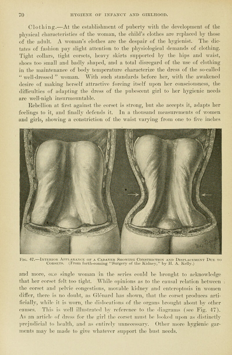Clothing.—At the establishment of puberty with the develoj)ment of the physical characteristics of the woman, the child's clothes are replaced by those of the adult. A woman's clothes are the despair of the hygienist. The dic- tates of fashion pay slight attention to the physiological demands of clotliing. Tight collars, tight corsets, heavy skirts supported by the hips and waist, shoes too small and badly shaped, and a total disregard of the use of clothing in the maintenance of body temperature characterize the dress of the so-called  well-dressed  woman. With such standards before her, with the awakened desire of making herself attractive forcing itself upon her consciousness, the difficulties of adajDting the dress of the pubescent girl to her hygienic needs are well-nigh insurmountable. Rebellion at first against the corset is strong, but she accepts it, adapts her feelings to it, and finally defends it. In a thousand measurements of women and girls, showing a constriction of the waist varying from one to five inches Fig. 47.—Interior Applarance of a Cadaver Showixg Constriction and Displacement Due to Corsets. (From forth-coming Sm-gery of the Kidnej', by H. A. Kelly.) and more, one single woman in the series could be brought to acknowledge that her corset felt too tight. While opinions as to the causal relation between the corset and pelvic congestions, movable kidney and enteroptosis in women differ, there is no doubt, as Glenard has shown, that the corset produces arti- ficially, while it is worn, the dislocations of the organs brought about by other causes. This is well illustrated by reference to the diagrams (see Fig. 47). As an article of dress for the girl the corset must be looked upon as distinctly prejudicial to healtli, and as entirely unnecessary. Other more hygienic gar- ments may be made to give whatever support the bust needs.