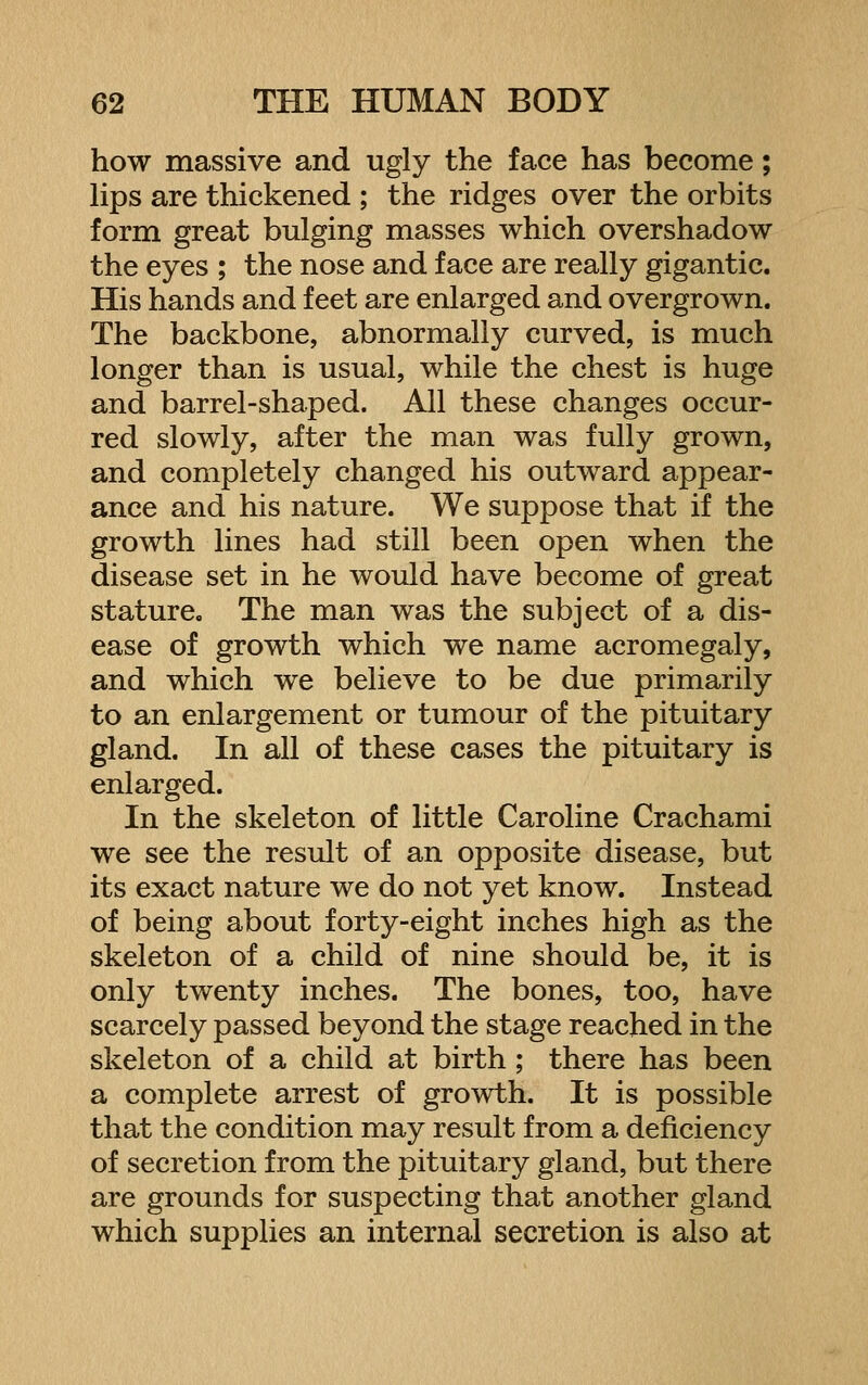 how massive and ugly the face has become; Hps are thickened ; the ridges over the orbits form great bulging masses which overshadow the eyes ; the nose and face are really gigantic. His hands and feet are enlarged and overgrown. The backbone, abnormally curved, is much longer than is usual, while the chest is huge and barrel-shaped. All these changes occur- red slowly, after the man was fully grown, and completely changed his outward appear- ance and his nature. We suppose that if the growth lines had still been open when the disease set in he would have become of great stature. The man was the subject of a dis- ease of growth which we name acromegaly, and which we believe to be due primarily to an enlargement or tumour of the pituitary gland. In all of these cases the pituitary is enlarged. In the skeleton of little Caroline Crachami we see the result of an opposite disease, but its exact nature we do not yet know. Instead of being about forty-eight inches high as the skeleton of a child of nine should be, it is only twenty inches. The bones, too, have scarcely passed beyond the stage reached in the skeleton of a child at birth ; there has been a complete arrest of growth. It is possible that the condition may result from a deficiency of secretion from the pituitary gland, but there are grounds for suspecting that another gland which supplies an internal secretion is also at