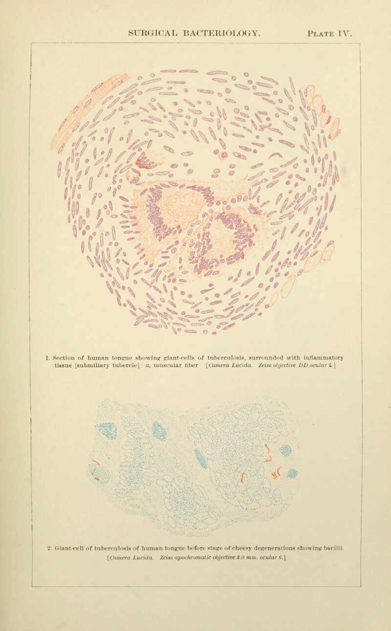 SURGilCAL liACTElllOLOCJY. Plate IV. Isjc^^* «™. .-^^^ ^SSS!^J^ 0 e B o m o^»' I hi i' i'-o i-^-k / 1. Section of human tonarue showing priant-cells of tuberculosis, aurronnded with inflammatory tissue [submiliary tubercle]: a, muscular liber [^Vamera Lucida. Zeiss ohjeclive Ul) ocular U] ^ V 2. Giant-cell of tuberculosis of human tongue before stage of cheesy degenerations showing bacilli. [Camera Lucida. Zeiss apochromatic objective 2.0 mm. octUar 6'.]