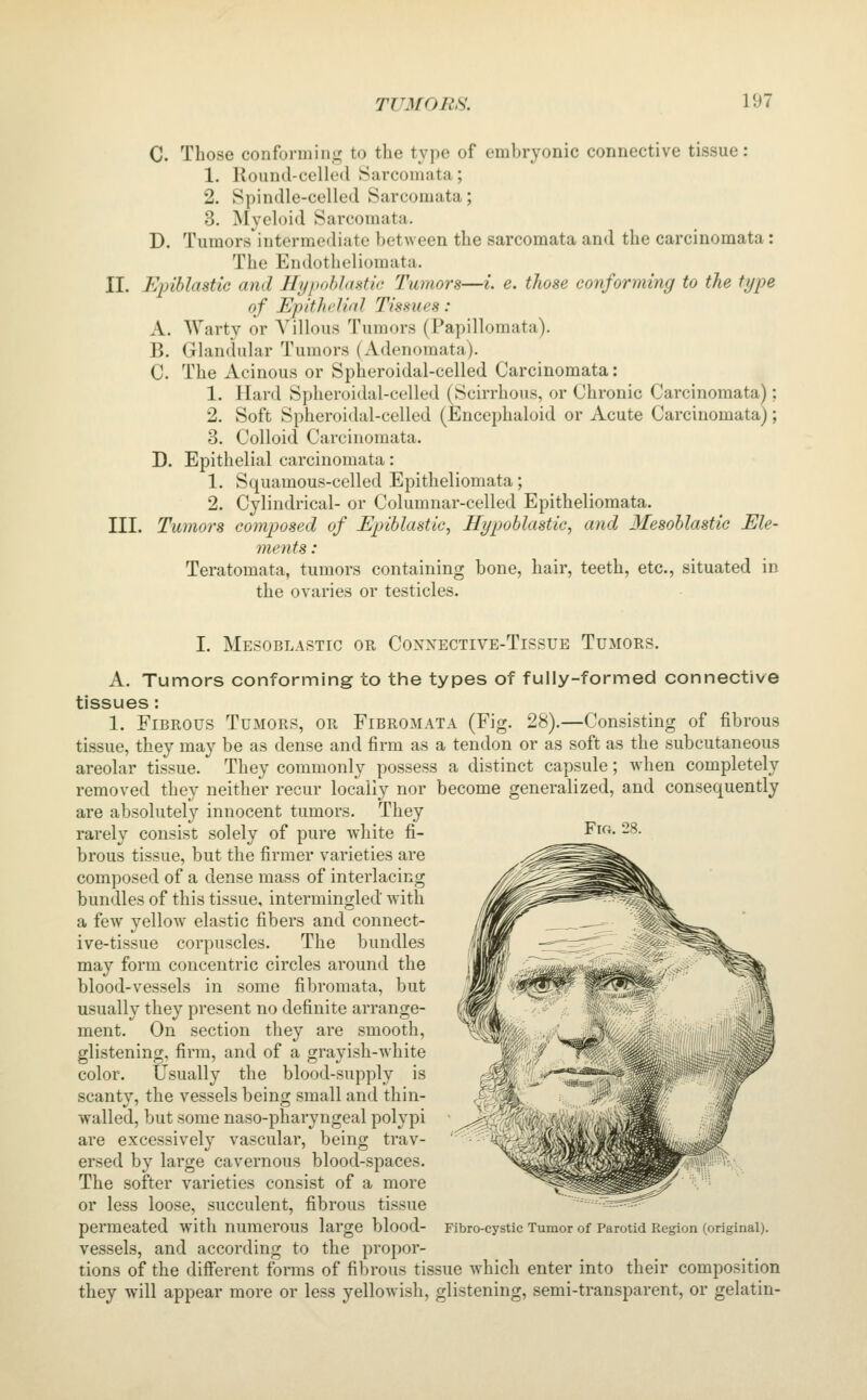 C. Those conformiiiii to the type of embryonic connective tissue: 1. liound-cclletl Sarcomata; 2. Spindle-celled Sarcomata; 3. Myeloid Sarcomata. D. Tumors intermediate between the sarcomata and the carcinomata: The Endotheliomata. II. Epiblastic and Ilypohlmtic Tumors—i. e. those conforming to the type of Epitlu'UaJ Tissues: A. Warty or Villous Tumors (Papillomata). B. Glandular Tumors (xVdenomata). C. The Acinous or Spheroidal-celled Carcinomata: 1. Hard Spheroidal-celled (Scirrhous, or Chronic Carcinomata^; 2. Soft Spheroidal-celled (Encephaloid or Acute Carcinomata); 3. Colloid Carcinomata. D. Epithelial carcinomata: 1. Squamous-celled Epitheliomata; 2. Cylindrical- or Columnar-celled Epitheliomata. III. Tumors composed of Epiblastic, Hypohlastic, and Mesohlastic Ele- ments : Teratomata, tumors containing bone, hair, teeth, etc., situated in the ovaries or testicles. I. Mesoblastic or Connective-Tissue Tumors. A. Tumors conforming to the types of fully-formed connective tissues : 1. Fibrous Tumors, or Fibromata (Fig. 28).—Consisting of fibrous tissue, they may be as dense and firm as a tendon or as soft as the subcutaneous areolar tissue. They commonly possess a distinct capsule; when completely removed they neither recur locally nor become generalized, and consequently are absolutely innocent tumors. They rarely consist solely of pure white fi- brous tissue, but the firmer varieties are composed of a dense mass of interlacing bundles of this tissue, intermingled with a few yellow elastic fibers and connect- ive-tissue corpuscles. The bundles may form concentric circles around the blood-vessels in some fibromata, but usually they present no definite arrange- ment. On section they are smooth, glistening, firm, and of a grayish-white color. Usually the blood-supply is scanty, the vessels being small and thin- walled, but some naso-pharyngeal polypi are excessively vascular, being trav- ersed by large cavernous blood-spaces. The softer varieties consist of a more or less loose, succulent, fibrous tissue vessels, and according to the propor- tions of the different forms of fibrous tissue which enter into their composition they will appear more or less yellowish, glistening, semi-transparent, or gelatin-