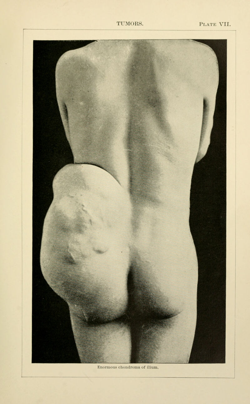 Enormous chondroma of ilium.