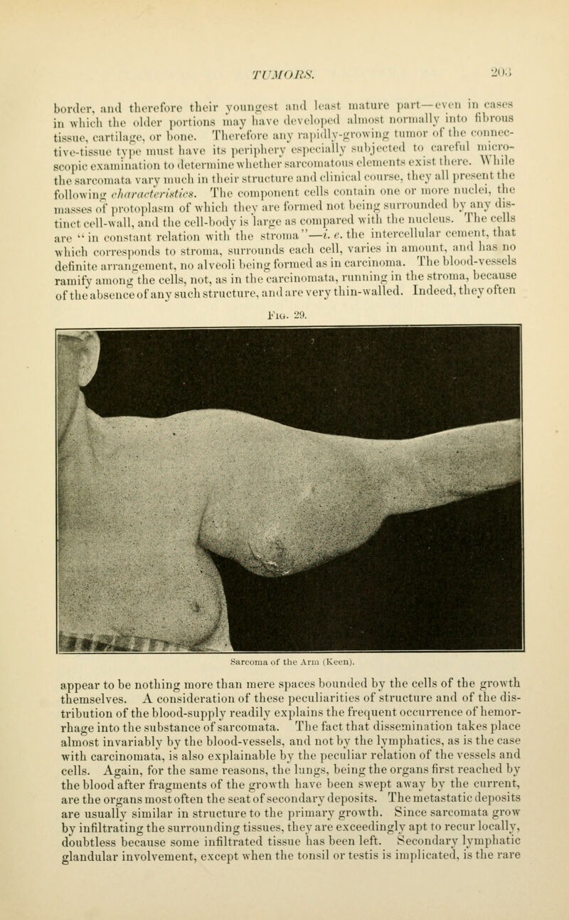 m.\ border, and therefore their youn^^est and least mature part—even in cases in which the okler portions may have developed almost normally into fibrous tissue, cartilage, or bone. Therefore any rapidly-growing tumor of the connec- tive-tissue tvjie must have its periphery especially subjected to careful micro- scopic examination to determine whether sarcomatous elements exist there. Wlnle the sarcomata vary much in their structure and clinical course, they all present the following characteristics. The component cells contain one or more nuclei, the masses of protoplasm of which they are formed not being surrounded by any dis- tinct cell-wall, and the cell-bodv is large as compared with the nucleus. The cells are  in constant relation with the stroma—z. e. the intercellular cement, that which corresponds to stroma, surrounds each cell, varies in amount, and has no definite arrangement, no alveoli being formed as in carcinoma. The blood-vessels ramify among the cells, not, as in the carcinomata, running in the stroma, because of the absence of any such structure, and are very thin-walled. Indeed, they often Fig. 29. Sarcoma of the Arm (Keenj. appear to be nothing more than mere spaces bounded by the cells of the growth themselves. A consideration of these peculiarities of structure and of the dis- tribution of the blood-supply readily explains the frequent occurrence of hemor- rhage into the substance of sarcomata. The fact that dissemination takes place almost invariably by the blood-vessels, and not by the lymphatics, as is the case with carcinomata, is also explainable by the peculiar relation of the vessels and cells. Again, for the same reasons, the lungs, being the organs first reached by the blood after fragments of the growth have been swept away by the current, are the organs most often the seat of secondary deposits. The metastatic deposits are usually similar in structure to the primary growth. Since sarcomata grow by infiltrating the surrounding tissues, they are exceedingly apt to recur locally, doubtless because some infiltrated tissue has been left. Secondary lymphatic glandular involvement, except when the tonsil or testis is implicated, is the rare