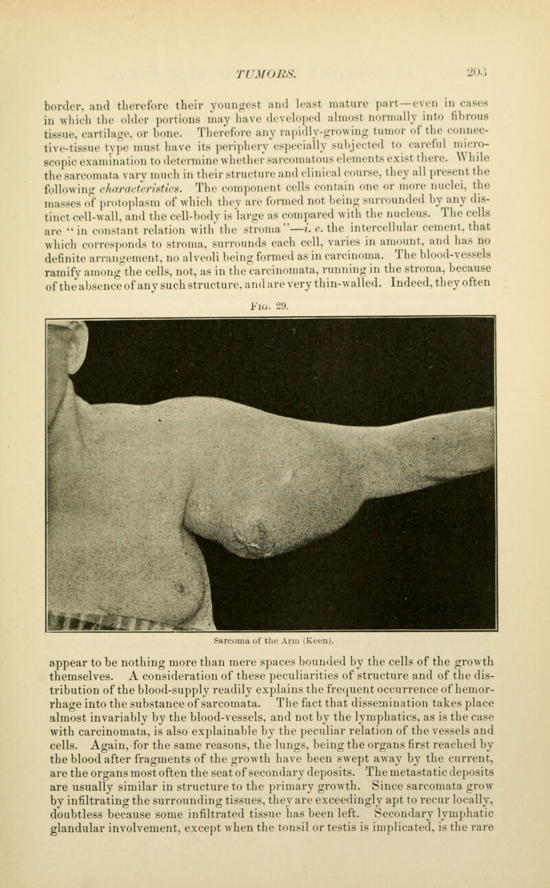 border, and therefore their youngest and least mature part—even in cases in wliieii the ohler portions may have developed almost normally into fibrous tissue, cartilage, or bone. Therefore any rapidly-growing tumor of the connec- tive-tissue tyi)e nmst have its periphery especially subjected to careful micro- scopic examination to determine whether sarcomatous elements exist there. AVhde the sarcomata vary much in their structure and clinical course, they all ])resent the following characteriiitics. The component cells contain one or more nuclei, the masses oi' protoplasm of which they are formed not being surrounded by any dis- tinct cell-wall, and the cell-body is 'large as compared with the nucleus. The cells are '^ in constant relation with the stroma—/, e. the intercellular cement, that which corresi)oruls to stroma, surrounds each cell, varies in amount, and has no definite arrangement, no alveoli being formed as in carcinoma. The blood-vessels ramify among the cells, not, as in the carcinomata, running in the stroma, because of the absence of any such structure, and are very thin-walled. Indeed, they often Fig. 29. .■sarcoma of the Arm ^Keun). appear to be nothing more than mere spaces bounded by the cells of the growth themselves. A consideration of these peculiarities of structure and of the dis- tribution of the blood-supply readily explains the frequent occurrence of hemor- rhage into the substance of sarcomata. The fact that dissemination takes place almost invariably by the blood-vessels, and not by the lymphatics, as is the case with carcinomata, is also explainable by the peculiar relation of the vessels and cells. Again, for the same reasons, the lungs, being the organs first reached by the blood after fragments of the growth have been swept away by the current, are the organs most often the seat of secondary deposits. The metastatic deposits are usually similar in structure to the primary growth. Since sarcomata grow by infiltrating the surrounding tissues, they are exceedingly apt to recur locally, doubtless because some infiltrated tissue has been left. Secondary lymphatic glandular involvement, except when the tonsil or testis is implicated, is the rare