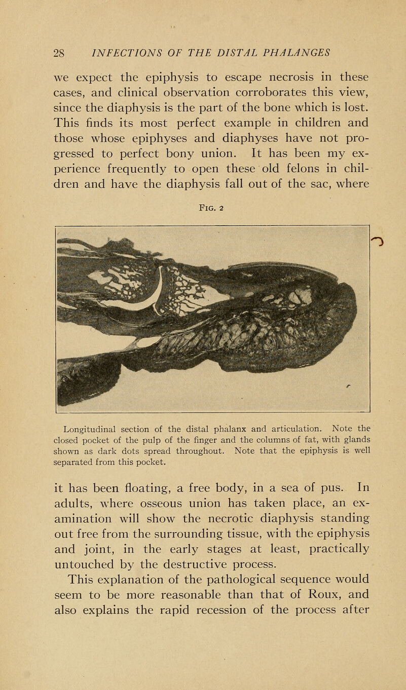 we expect the epiphysis to escape necrosis in these cases, and cHnical observation corroborates this view, since the diaphysis is the part of the bone which is lost. This finds its most perfect example in children and those whose epiphyses and diaphyses have not pro- gressed to perfect bony union. It has been my ex- perience frequently to open these old felons in chil- dren and have the diaphysis fall out of the sac, where Fig. 2 Longitudinal section of the distal phalanx and articulation. Note the closed pocket of the pulp of the finger and the columns of fat, with glands shown as dark dots spread throughout. Note that the epiphysis is well separated from this pocket. it has been floating, a free body, in a sea of pus. In adults, where osseous union has taken place, an ex- amination will show the necrotic diaphysis standing out free from the surrounding tissue, with the epiphysis and joint, in the early stages at least, practically untouched by the destructive process. This explanation of the pathological sequence would seem to be more reasonable than that of Roux, and also explains the rapid recession of the process after