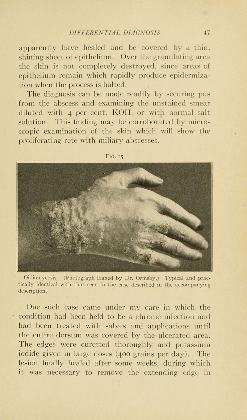 apparently liave healed and be covered by a ihin, shinin.c sheet of epithelium. Over the granulating^ area the skin is not completely destroyed, since areas of epithelium remain which rapidh' produce epidermiza- tion when the process is halted. The diagnosis can be made readil>- b>- securing pus from the abscess and examining the unstained smear diluted with 4 per cent. KOH, (jr with normal salt solution. This finding may be corroborated by micro- scopic examination of the skin w^hich will show the proliferating rete with miliary abscesses. Fig. 15 1 1 iP^^- ■L^ ^ 1 ■ H m ff^ 1 Ik ^^H '- I^P ■4^ « ^ ^ ^^ 1 ^^ ^^^^m^ Hi B2^ ^^^^^BH Oidiomycosis. (Photograph loaned by Dr. Ormsby.) Typical and prac- tically identical with that seen in the case described in the accompanying description. One such case came under my care in which the condition had been held to be a chronic infection and had been treated with salves and applications until the entire dorsum was covered by the ulcerated area. The edges were curetted thoroughly- and potassium iodide given in large doses (400 grains per day). The lesion finally healed after some weeks, during which it was necessary to remove the extending edge in