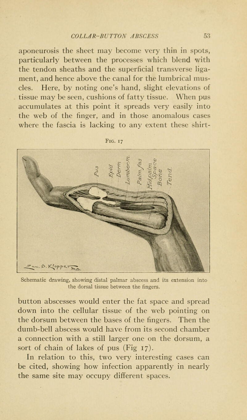 aponeurosis the sheet may become very thin in spots, particularly between the processes which blend with the tendon sheaths and the superficial transverse liga- ment, and hence above the canal for the lumbrical mus- cles. Here, by noting one's hand, slight elevations of tissue may be seen, cushions of fatty tissue. When pus accumulates at this point it spreads very easily into the web of the finger, and in those anomalous cases where the fascia is lacking to any extent these shirt- FiG. 17 Schematic drawing, showing distal paknar abscess and its extension into the dorsal tissue between the fingers. button abscesses would enter the fat space and spread down into the cellular tissue of the web pointing on the dorsum between the bases of the fingers. Then the dumb-bell abscess would have from its second chamber a connection with a still larger one on the dorsum, a sort of chain of lakes of pus (Fig 17). In relation to this, two very interesting cases can be cited, showing how infection apparently in nearly the same site may occupy different spaces.