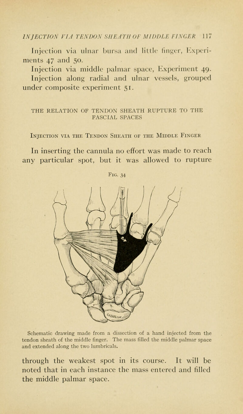 liiji-ction via ulnar Idirsa and litllc Imi^cr, I'-xpcri- nicnts 47 and 50. Injccticjii via middk- ])alniar space, I'.xj^triiULiit 49. Injection along radial and ulnar vessels, grouped under composite experinunl 51. THE RELATION OF TENDON SHEATH RUPTURE TO THE FASCIAL SPACES Injection via the Tendon Sheath of the Middle Finger In inserting the cannula no effort was made to reach any particular spot, but it was allowed to rupture Schematic drawing made from a dissection of a hand injected from the tendon sheath of the middle finger. The mass filled the middle palmar space and extended along the two lumbricals. through the weakest spot in its course. It will be noted that in each instance the mass entered and tilled the middle palmar space.