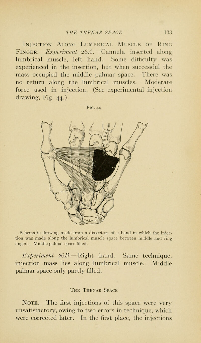 Injection Along Lumi'.kk al Muscli-: oi- KiNci Finger.—Experiment 26A.—Cannula inserted along lumbrical muscle, left hand. Some difficulty was experienced in the insertion, but when successful the mass occupied the middle palmar space. There w^as no return along the lumbrical muscles. Moderate force used in injection. (See experimental injection drawing, Fig. 44.) Fig. 44 Schematic drawing made from a dissection of a hand in which the injec- tion was made along the lumbrical muscle space between middle and ring fingers. Middle palmar space filled. Experimejit 26B.—Right hand. Same technique, injection mass lies along lumbrical muscle. Middle palmar space only partly filled. The Thenar Space Note.—The first injections of this space were very unsatisfactory, owing to two errors in technique, which were corrected later. In the first place, the injections