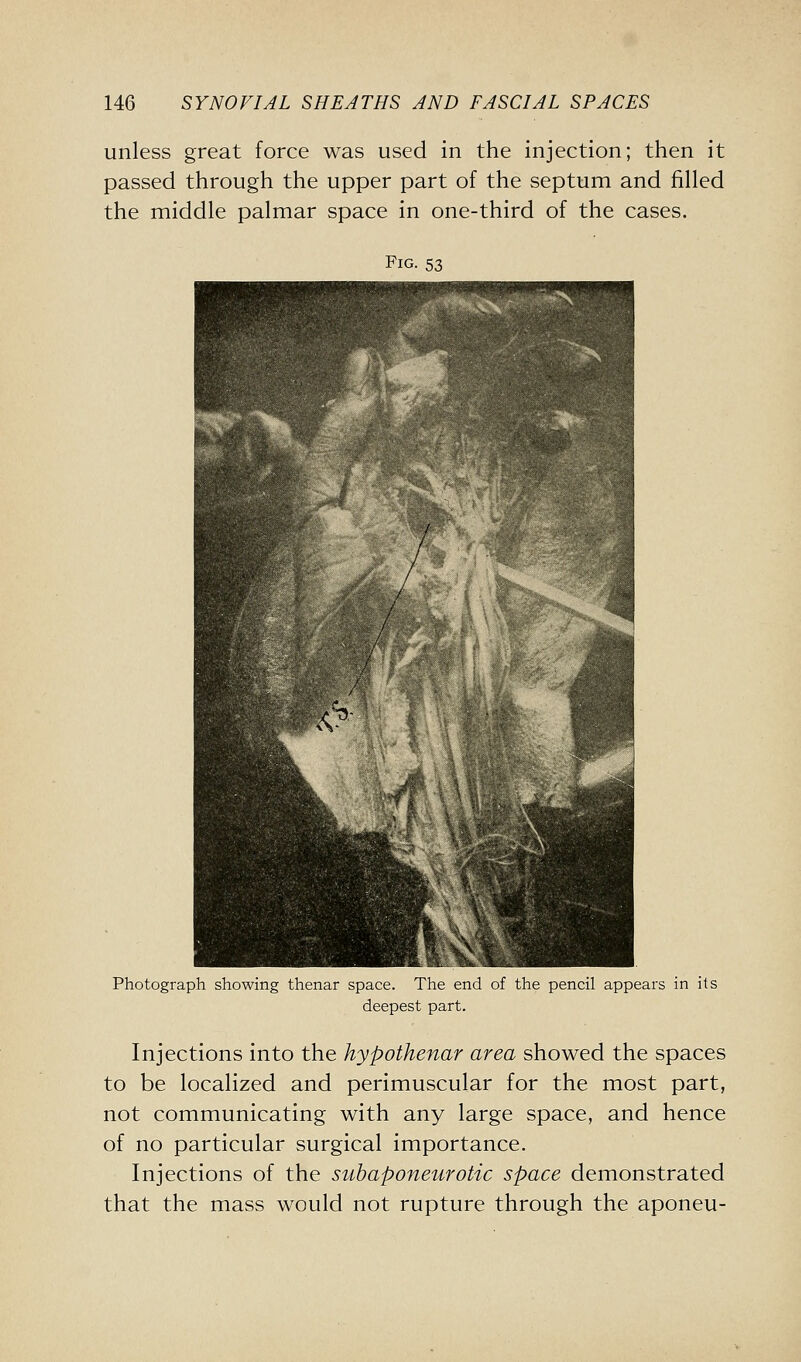 unless great force was used in the injection; then it passed through the upper part of the septum and filled the middle palmar space in one-third of the cases. Fig. 53 Photograph showing thenar space. The end of the pencil appears in its deepest part. Injections into the hypothenar area showed the spaces to be localized and perimuscular for the most part, not communicating with any large space, and hence of no particular surgical importance. Injections of the subaponeurotic space demonstrated that the mass would not rupture through the aponeu-