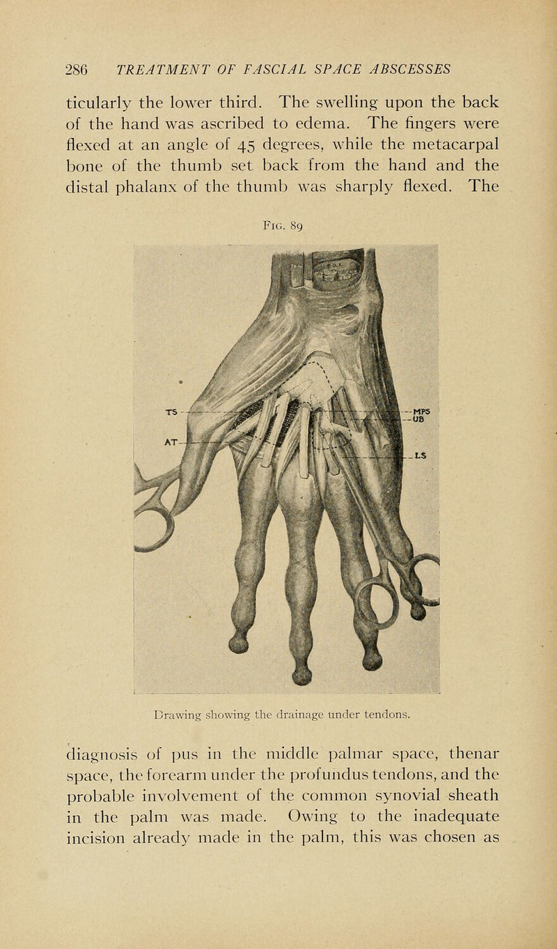 ticularly the lower third. The vSwelhng upon the back of the hand was ascribed to edema. The fingers were flexed at an angle of 45 degrees, while the metacarpal bone of the thumb set back from the hand and the distal phalanx of the thumb was sharply flexed. The Fig. MPS OB Drawing showing the drainage under tendons. diagnosis of pus in the middle palmar space, thenar space, the forearm under the profundus tendons, and the probable involvement of the common synovial sheath in the palm was made. Owing to the inadequate incision already made in the palm, this was chosen as