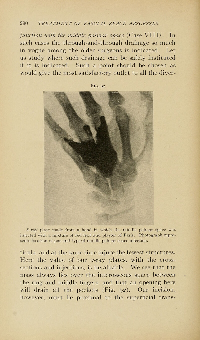 junction with the middle palmar space (Case VIII). In such cases the through-and-through drainage so much in vogue among the older surgeons is indicated. Let us study where such drainage can be safely instituted if it is indicated. Such a point should be chosen as would give the most satisfactory outlet to all the diver- FiG. 92 X-ray plate made from a hand in which the middle palmar space was injected with a mixture of red lead and plaster of Paris. Photograph repre- sents location of pus and typical middle palmar space infection. ticula, and at the same time injure the fewest structures. Here the value of our x-ray plates, with the cross- sections and injections, is invaluable. We see that the mass always lies over the interosseous space between the ring and middle fingers, and that an opening here will drain all the pockets (Fig. 92). Our incision, however, must lie proximal to the superficial trans-