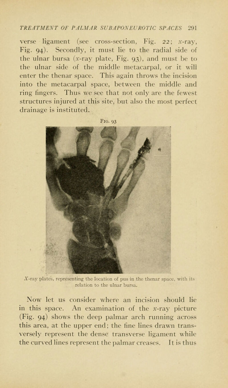 verse ligament (see cross-section, Fi.u. 22; .v-ra>% Fig. 94). Secondly, it must lir to the radial side of the ulnar bursa {.v-ra>- plate, Fig. 93), and must be to the ulnar side of the middle metarari)al, or it will enter the thenar space. This again throws the incision into the metacarpal space, between the middle and ring fingers. Thus we see that not only are the few^est structures injured at this site, l)ut also the most perfect drainage is instituted. Fig. 93 A'-ray plates, representing the location of pus in the thenar space, with its relation to the ulnar bursa. Now let us consider where an incision should lie in this space. An examination of the .r-ray picture (Fig. 94) shows the deep palmar arch running across this area, at the upper end; the fine lines drawn trans- versely represent the dense transverse ligament while the cur\ed lines represent the j-)almar creases. It is thus