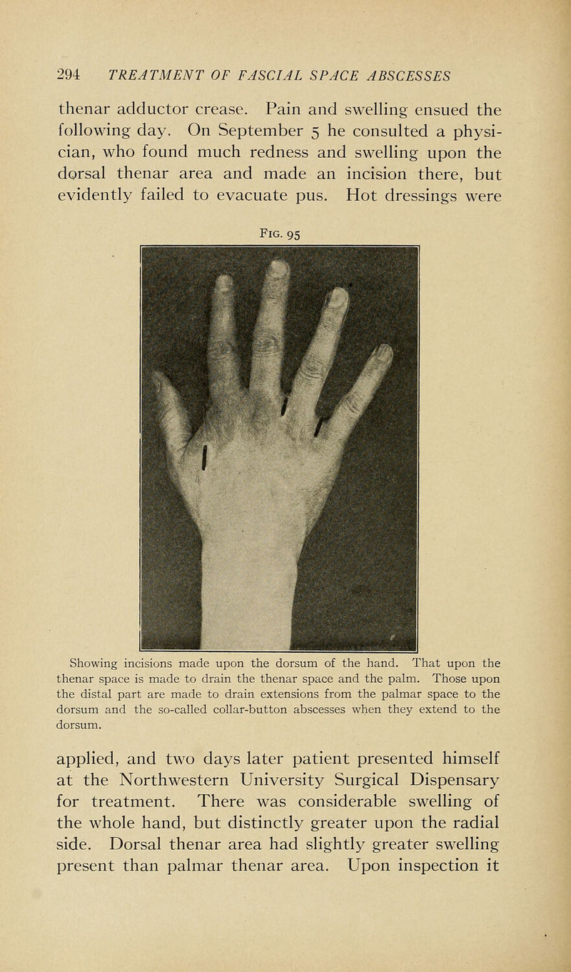 thenar adductor crease. Pain and swelling ensued the following day. On September 5 he consulted a physi- cian, who found much redness and swelling upon the dorsal thenar area and made an incision there, but evidently failed to evacuate pus. Hot dressings were Fig. 95 Showing incisions made upon the dorsum of the hand. That upon the thenar space is made to drain the thenar space and the palm. Those upon the distal part are made to drain extensions from the palmar space to the dorsum and the so-called collar-button abscesses when they extend to the dorsum. applied, and two days later patient presented himself at the Northwestern University Surgical Dispensary for treatment. There was considerable swelling of the whole hand, but distinctly greater upon the radial side. Dorsal thenar area had slightly greater swelling present than palmar thenar area. Upon inspection it